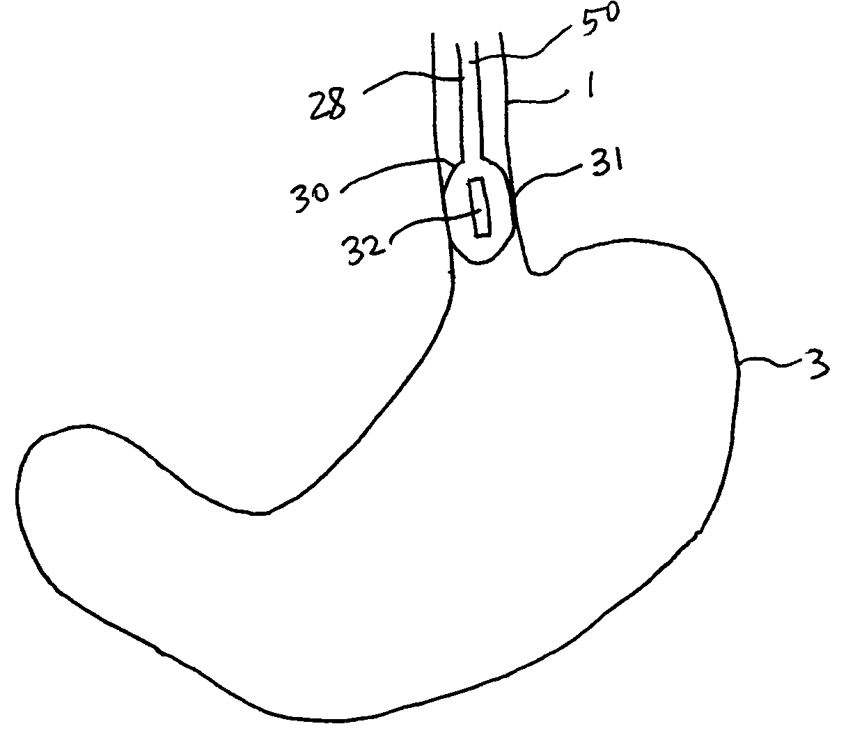 Methods and apparatus for testing disruption of a vagal nerve