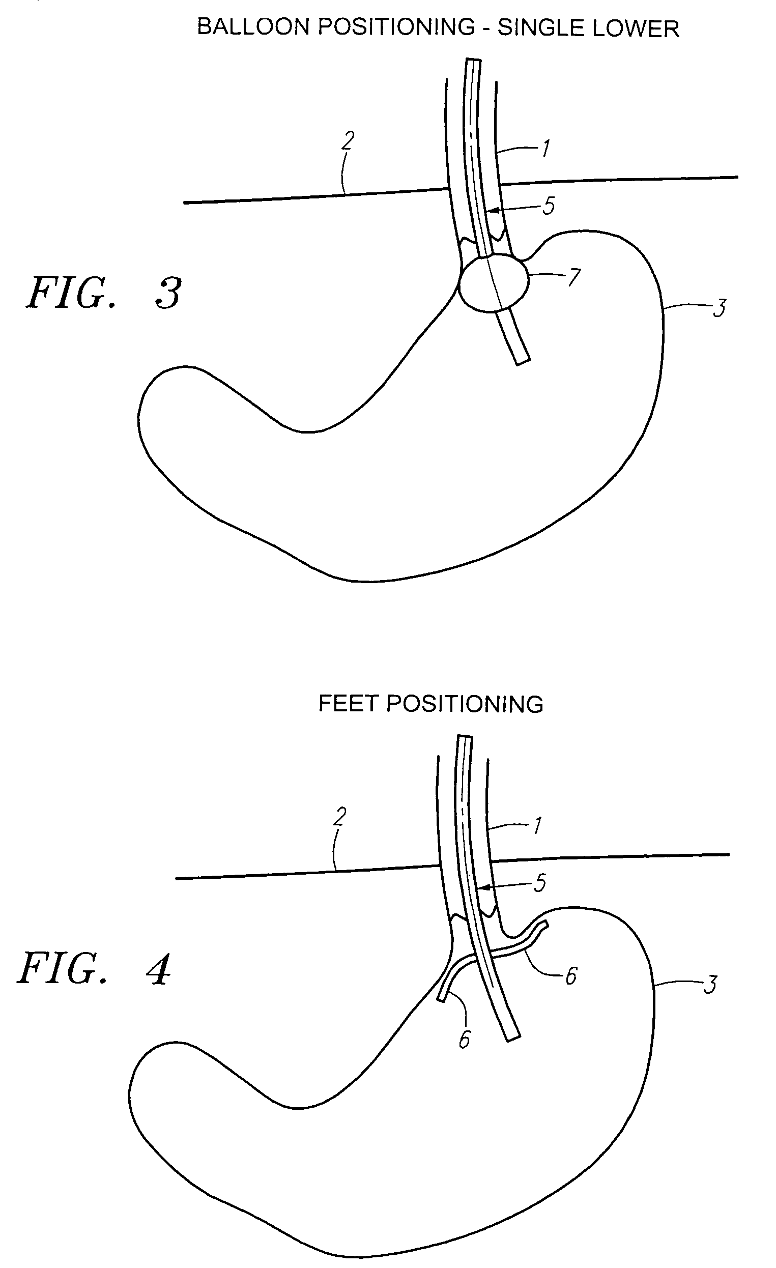 Methods and apparatus for testing disruption of a vagal nerve