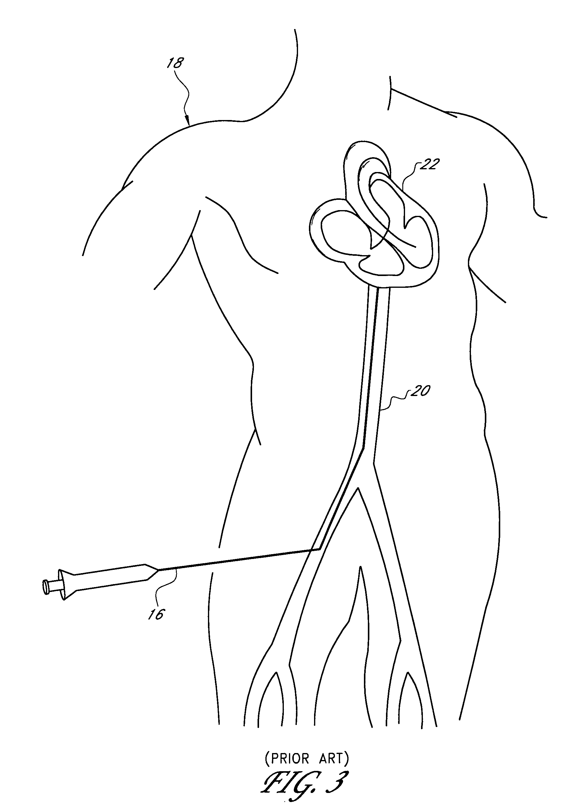 Apparatus and method for non-invasive diagnosing of coronary artery disease