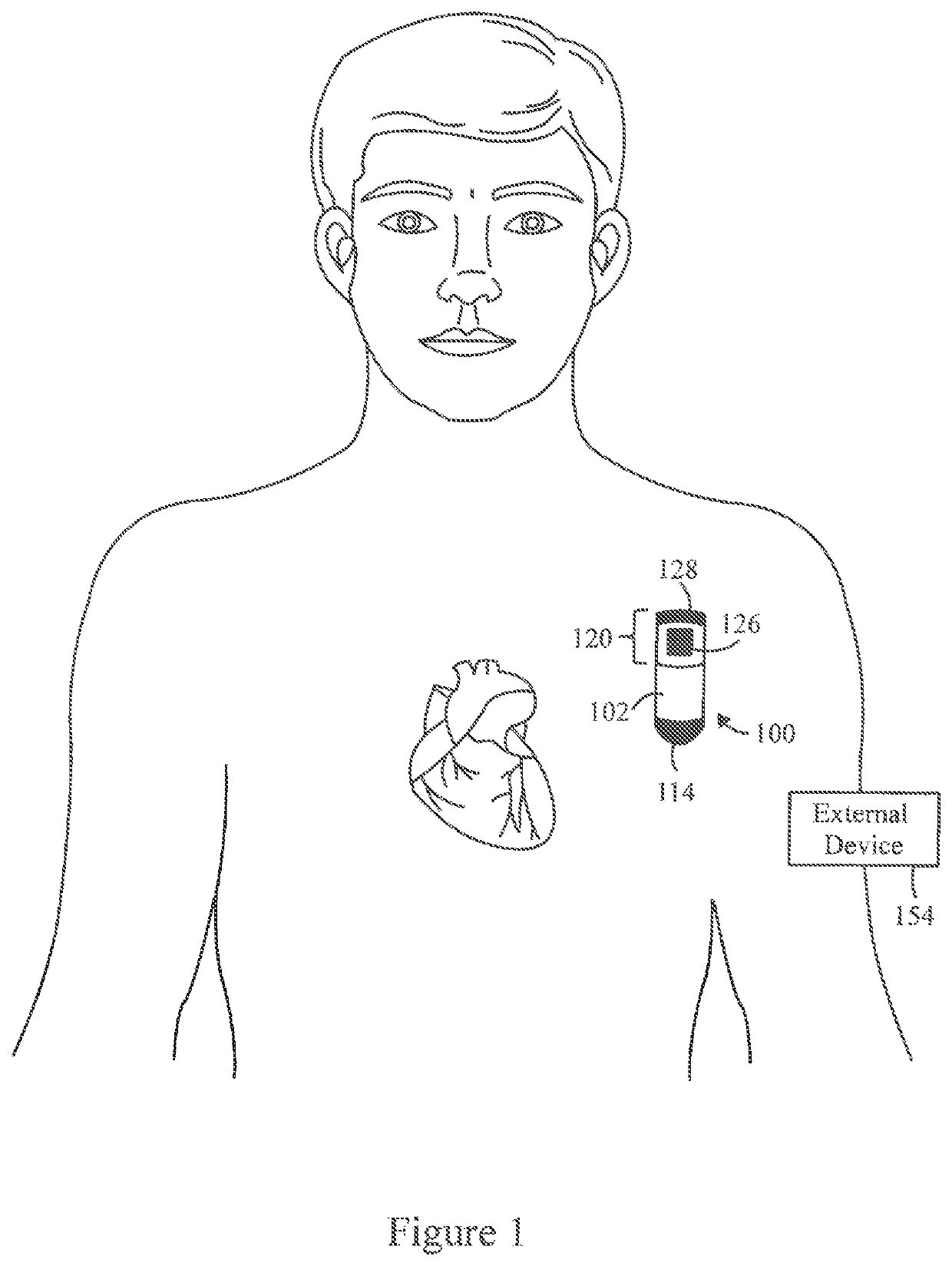 Atrial flutter detection utilizing nonlinear dimension reduction