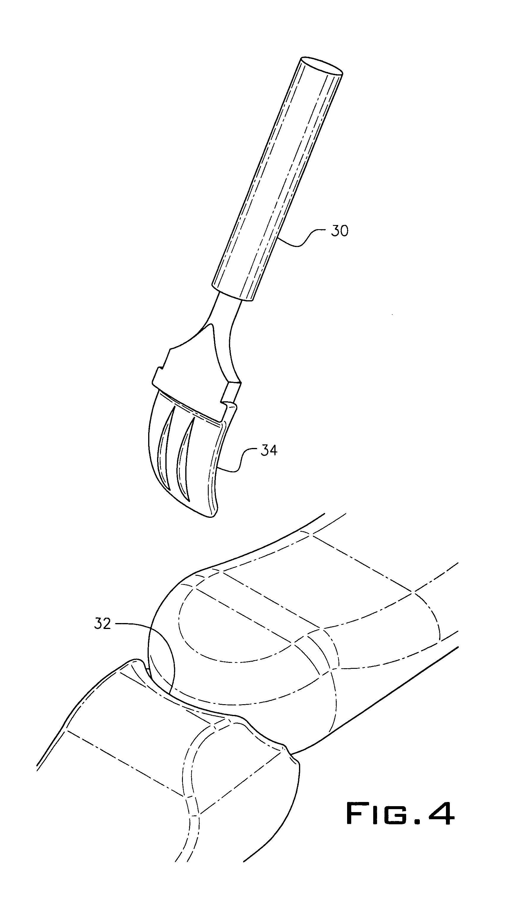 Implant device used in minimally invasive facet joint hemi-arthroplasty