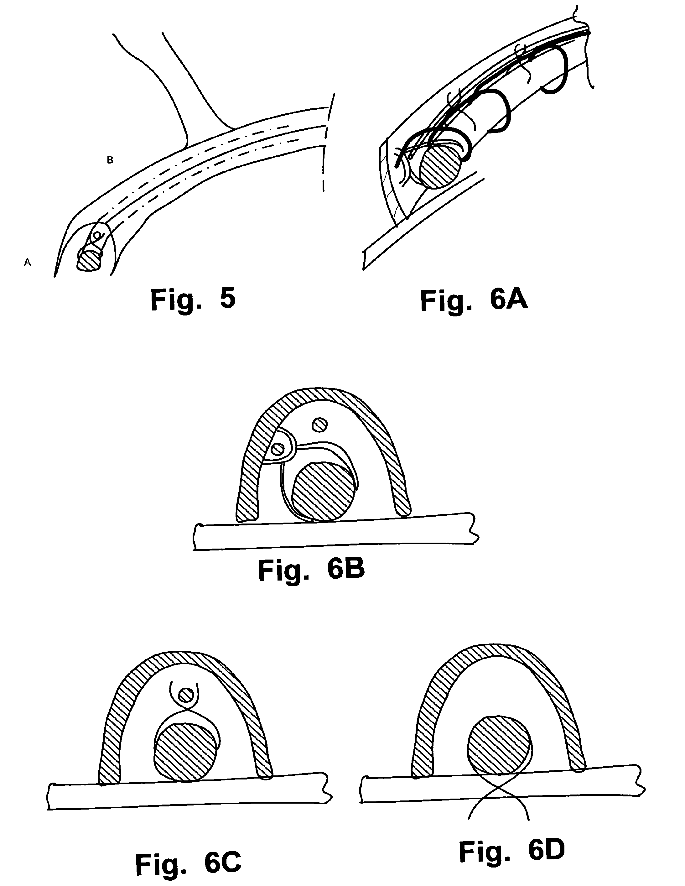 Delivery Device For Medical Implant And Medical Procedure