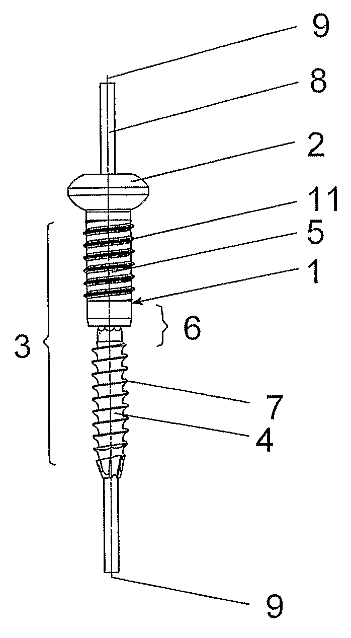 Articulated Bone Screw