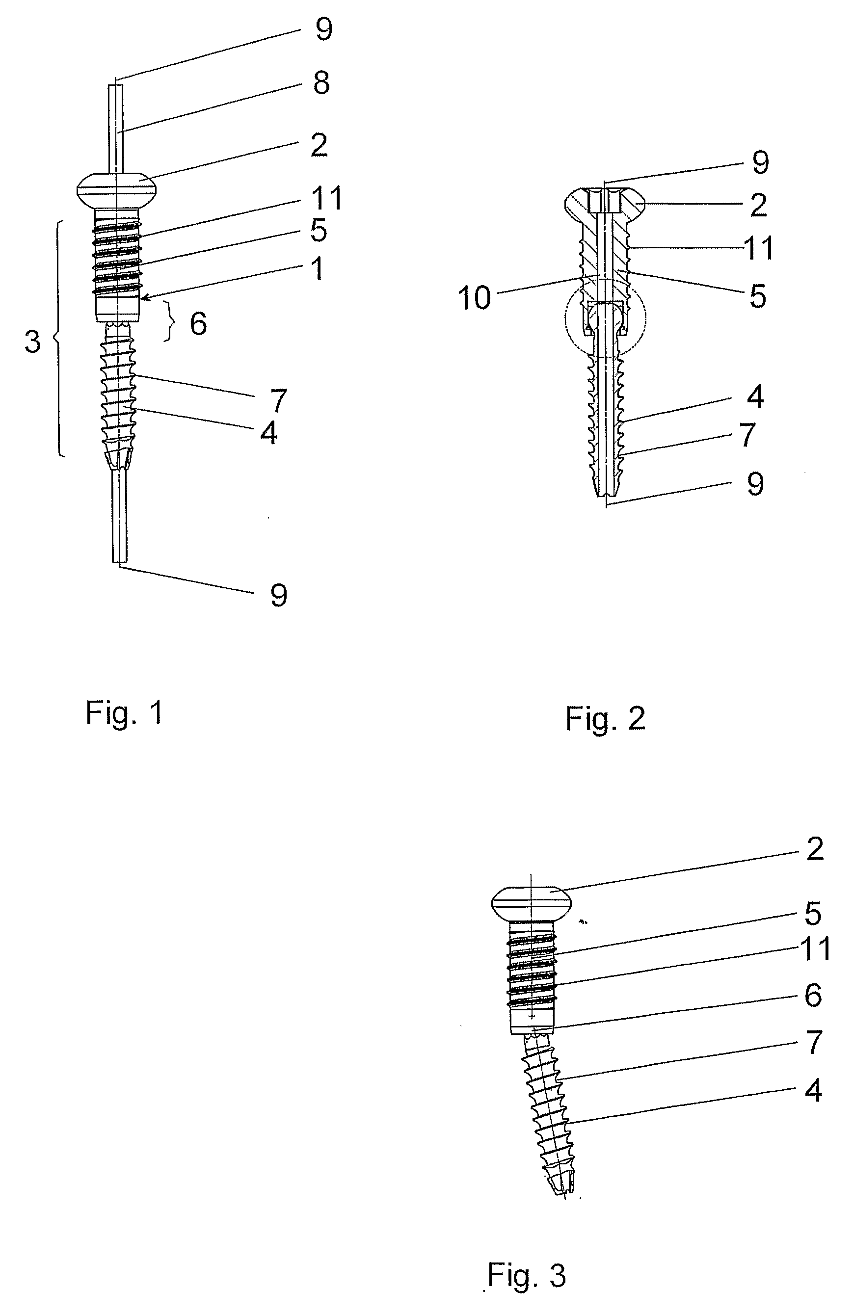 Articulated Bone Screw