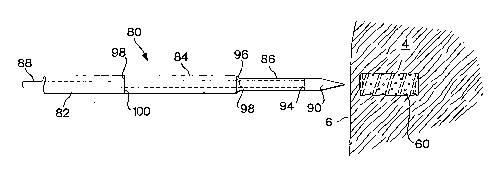 Flexible vascular inducing implants