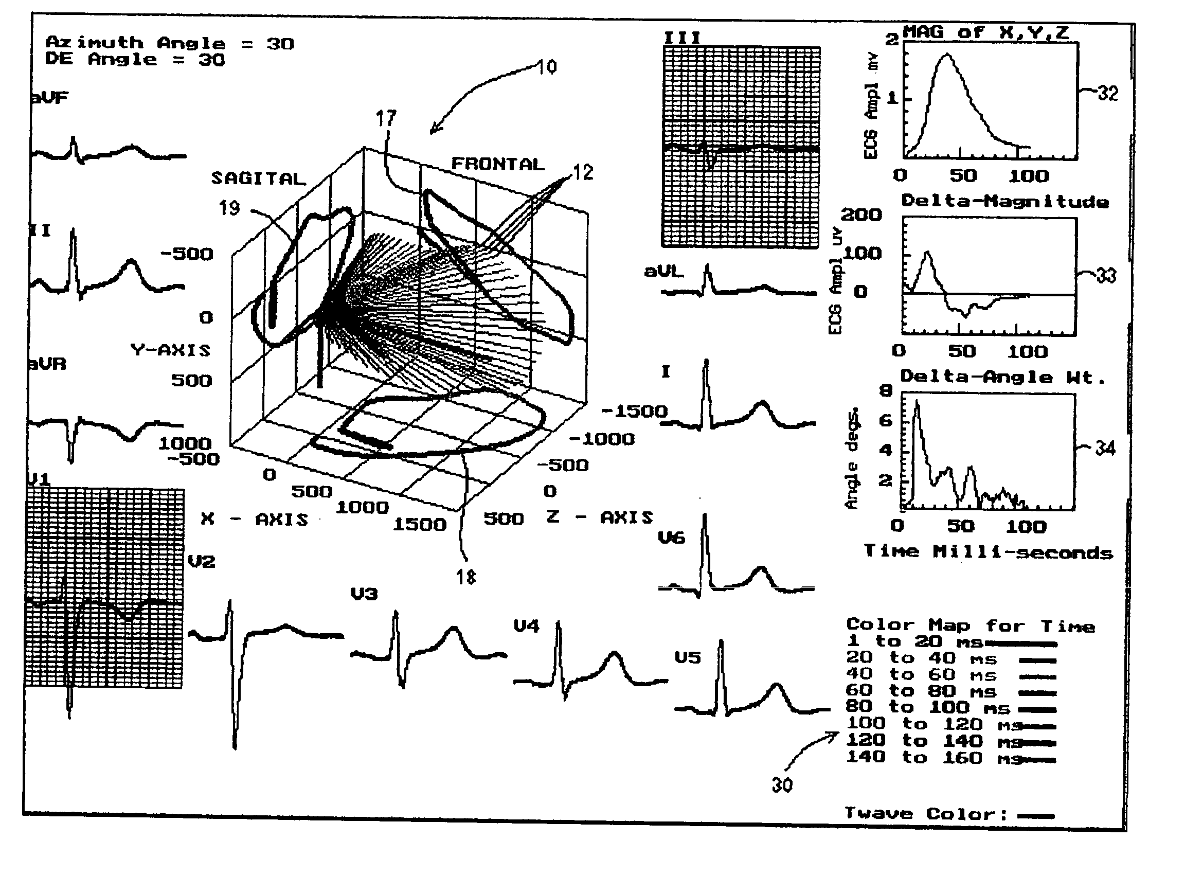 Three dimensional vector cardiograph and method for detecting and monitoring ischemic events