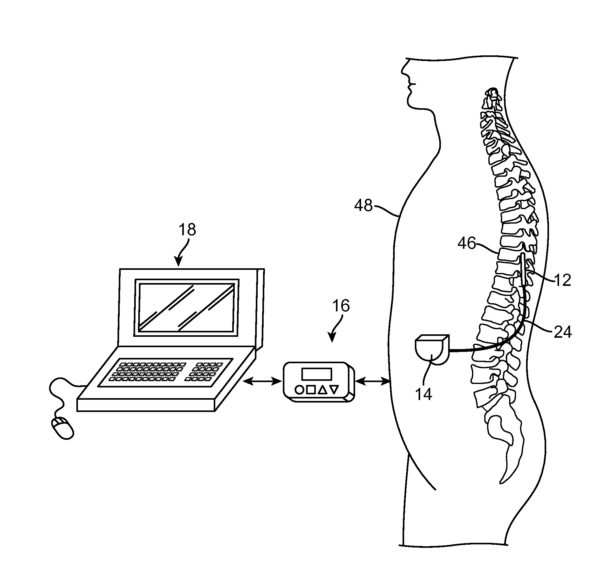 Use of compound action potentials to automatically adjust neurostimulation therapy in response to postural changes of patient