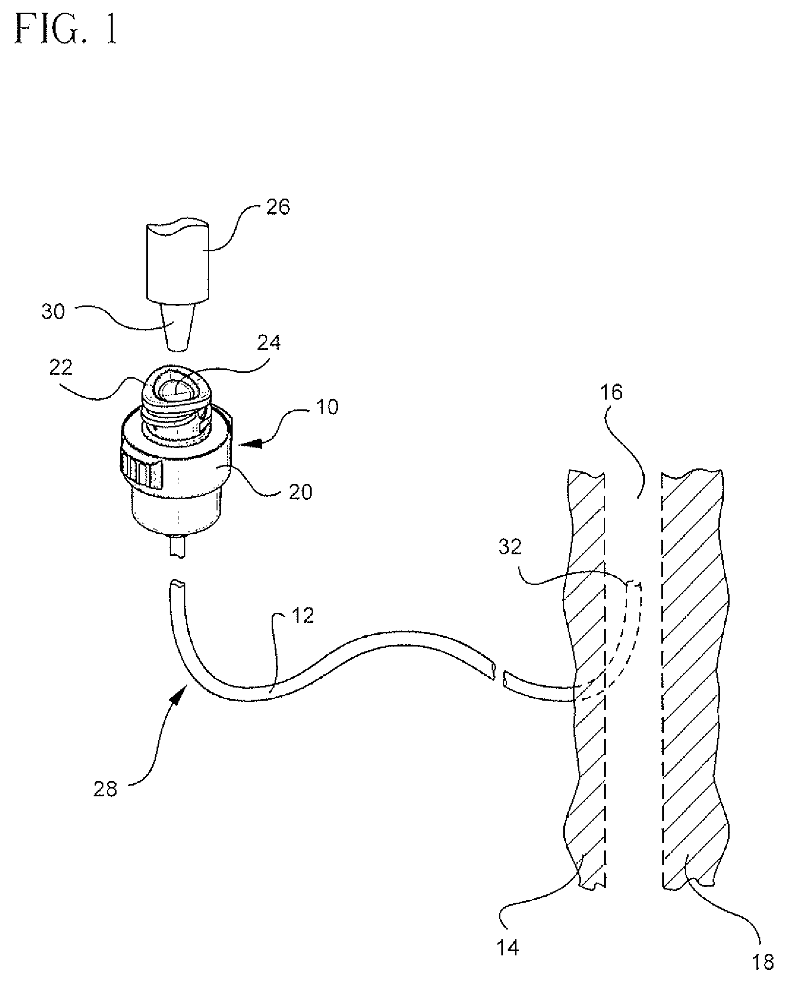 Vascular access device volume displacement