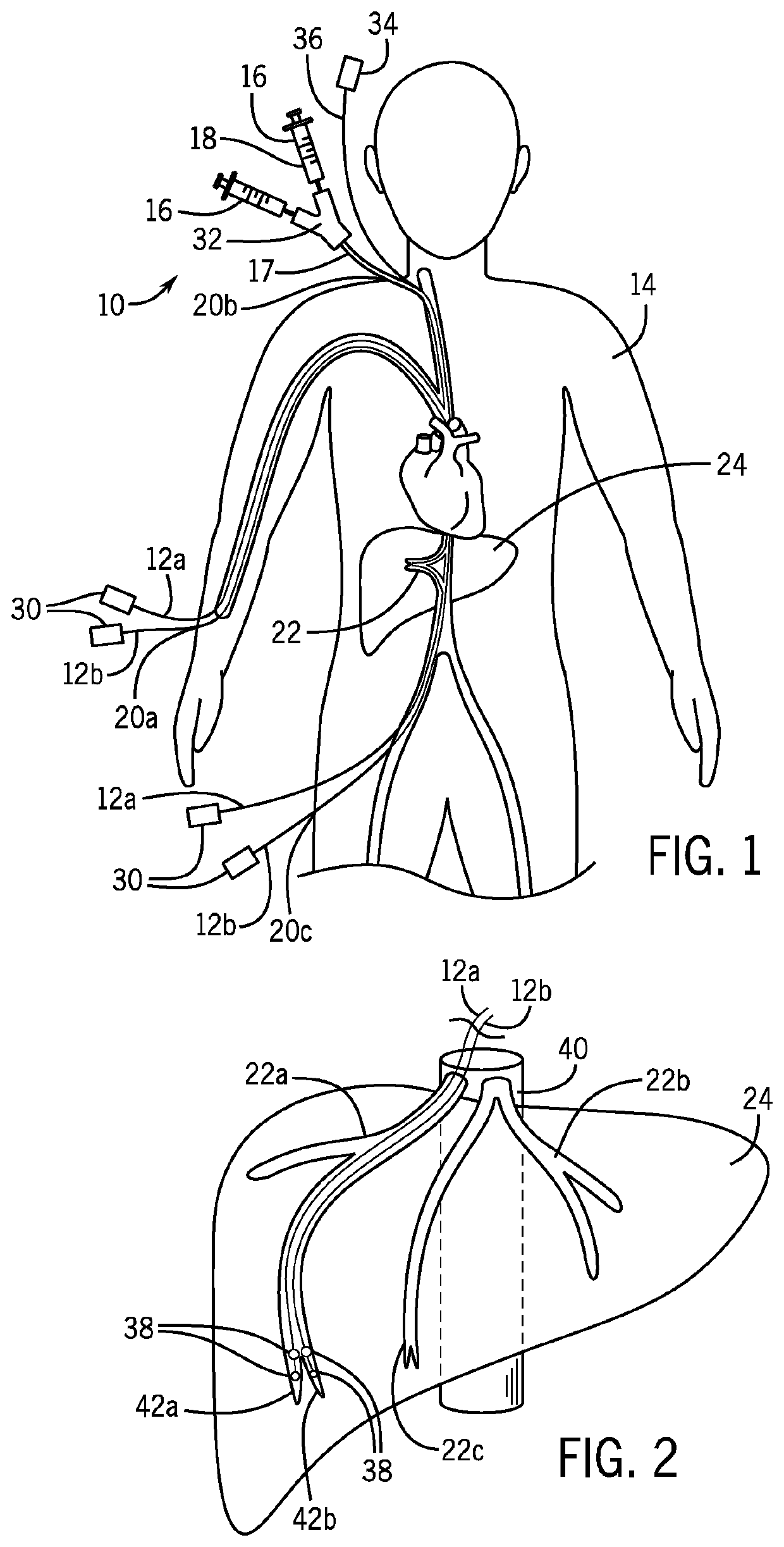 In vivo gene therapy delivery procedure and device