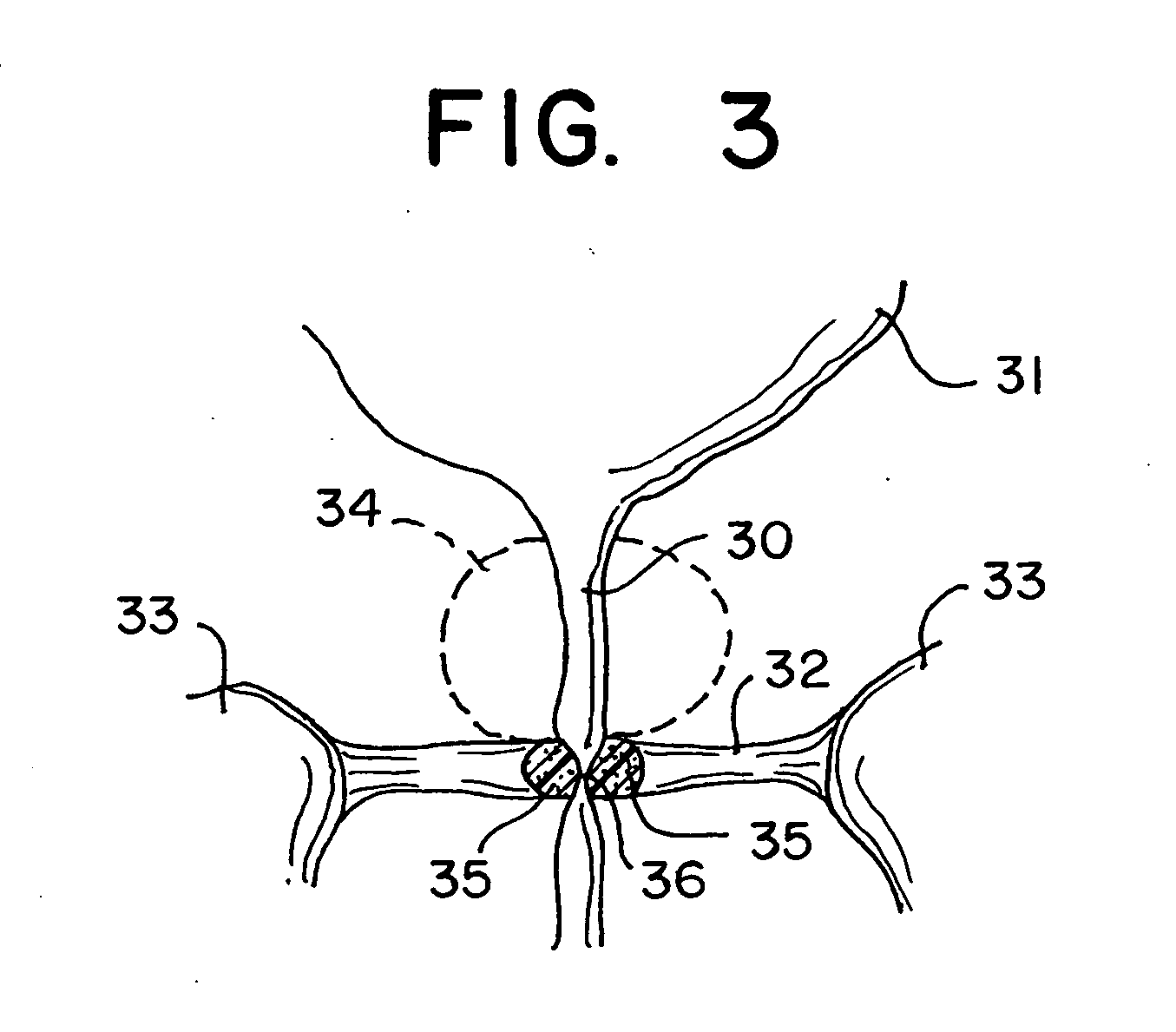 Soft tissue substitute and method of soft tissue reformation