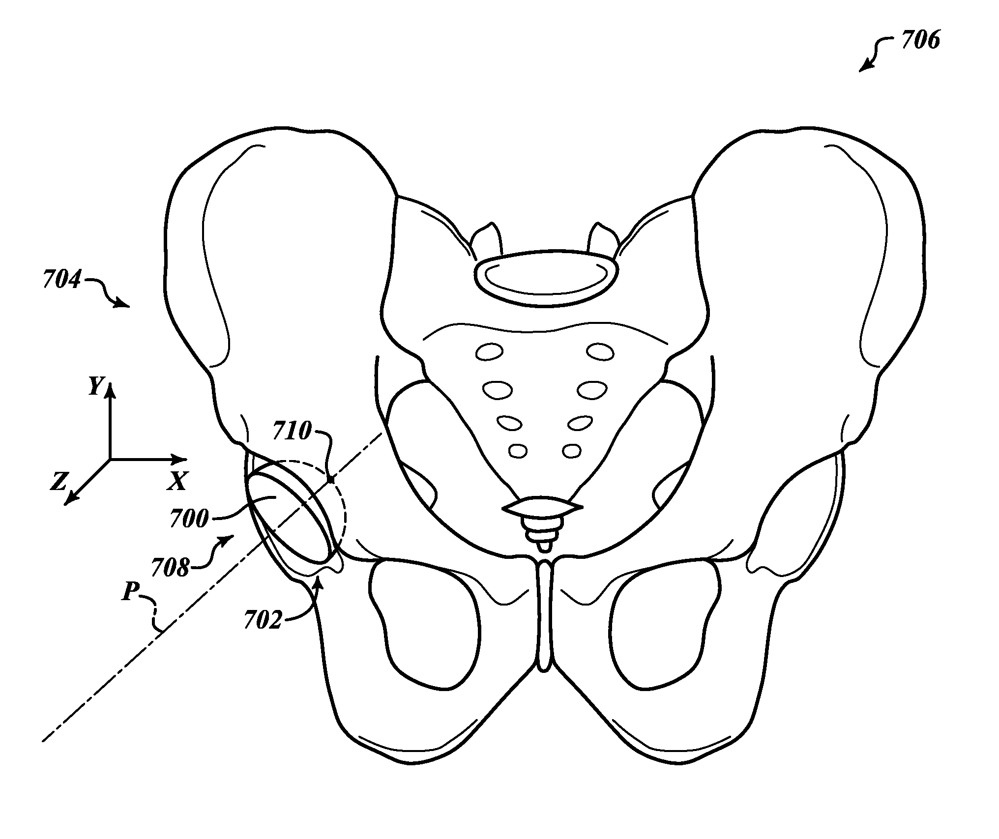 Devices and methods for hip replacement