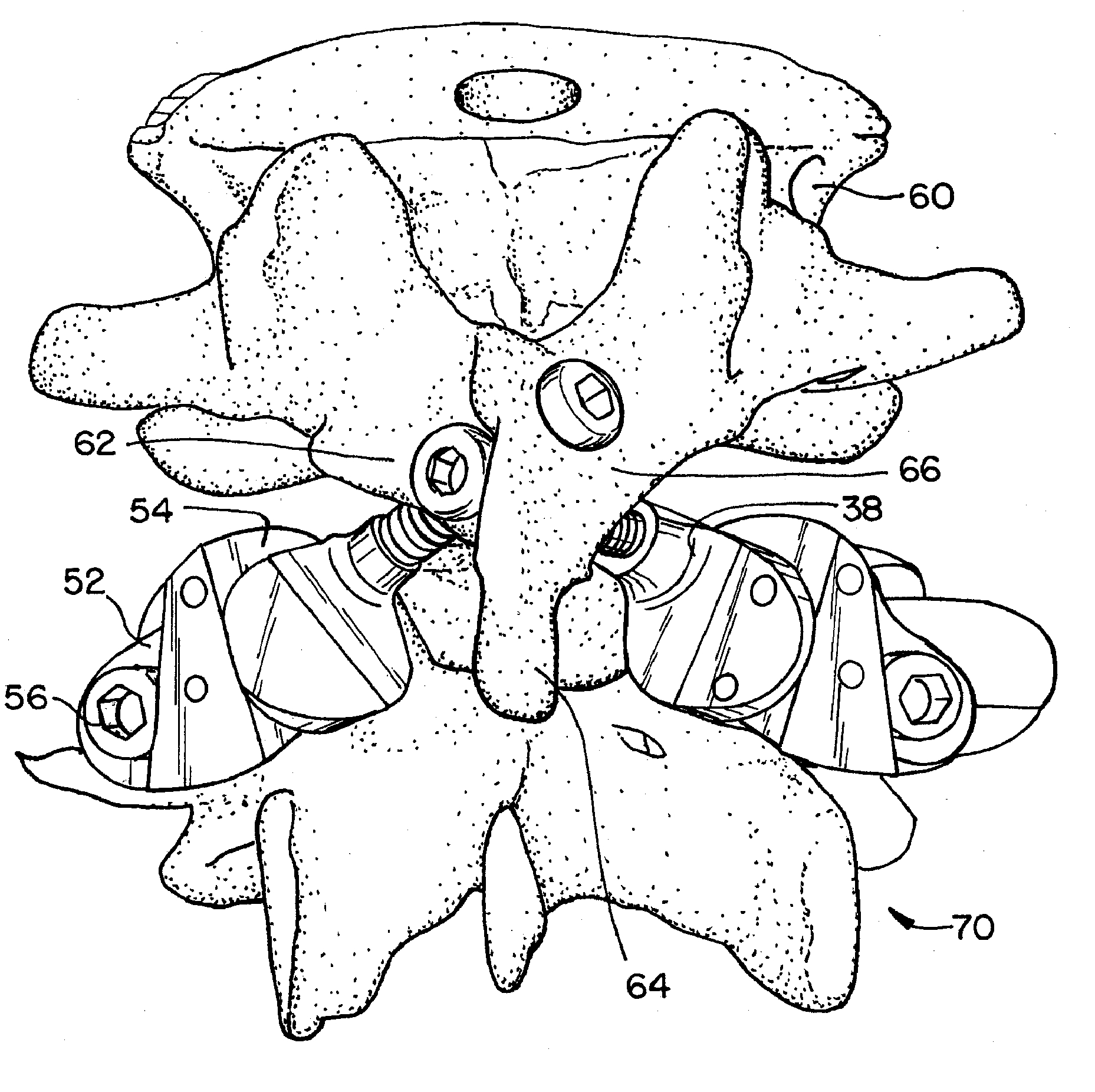 Prostheses, Tools And Methods For Replacement Of Natural Facet Joints With Artificial Facet Joint Surfaces