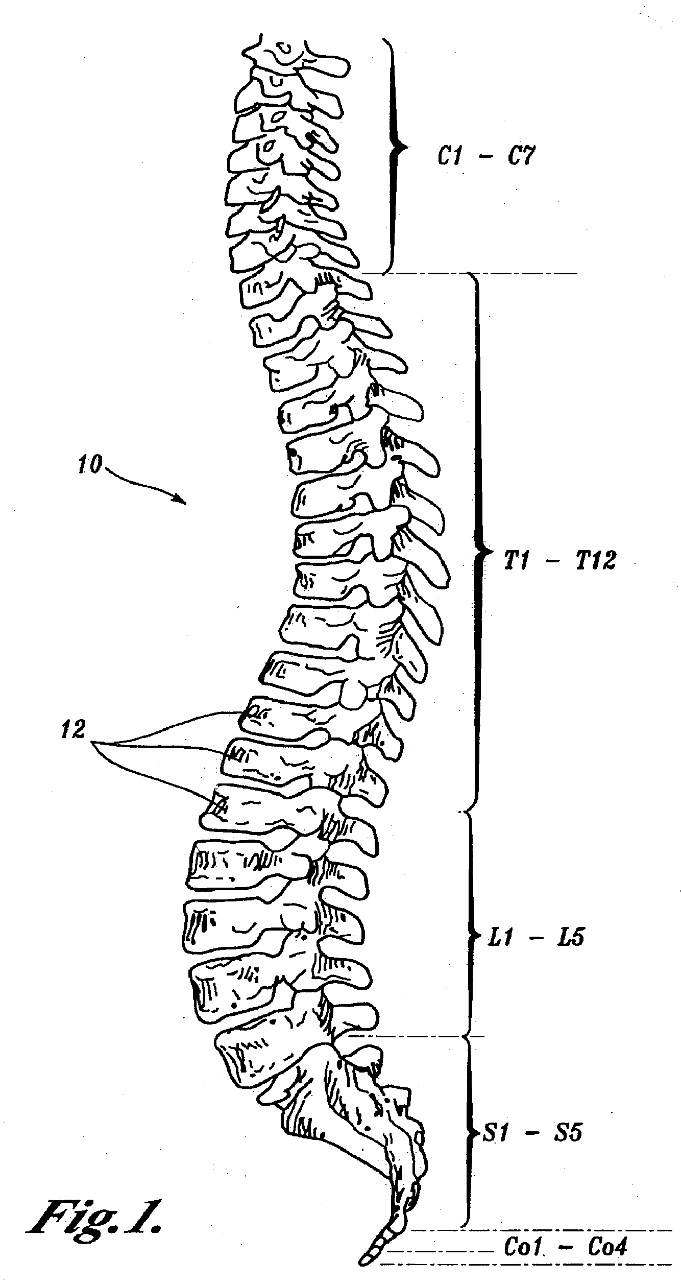 Prostheses, Tools And Methods For Replacement Of Natural Facet Joints With Artificial Facet Joint Surfaces