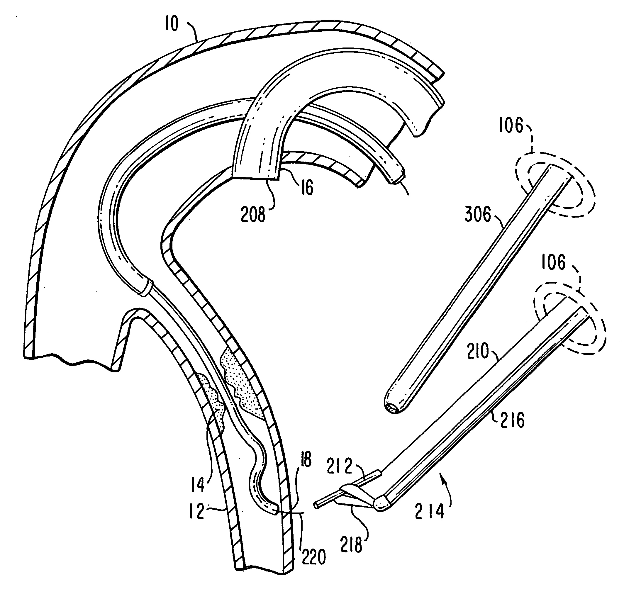 Medical grafting methods and apparatus