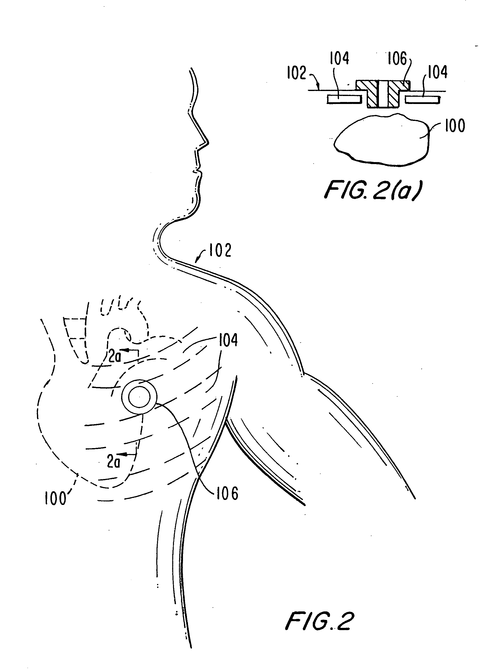 Medical grafting methods and apparatus