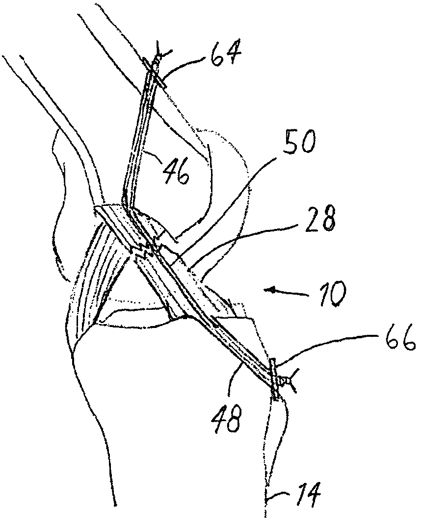 Anterior cruciate ligament tether