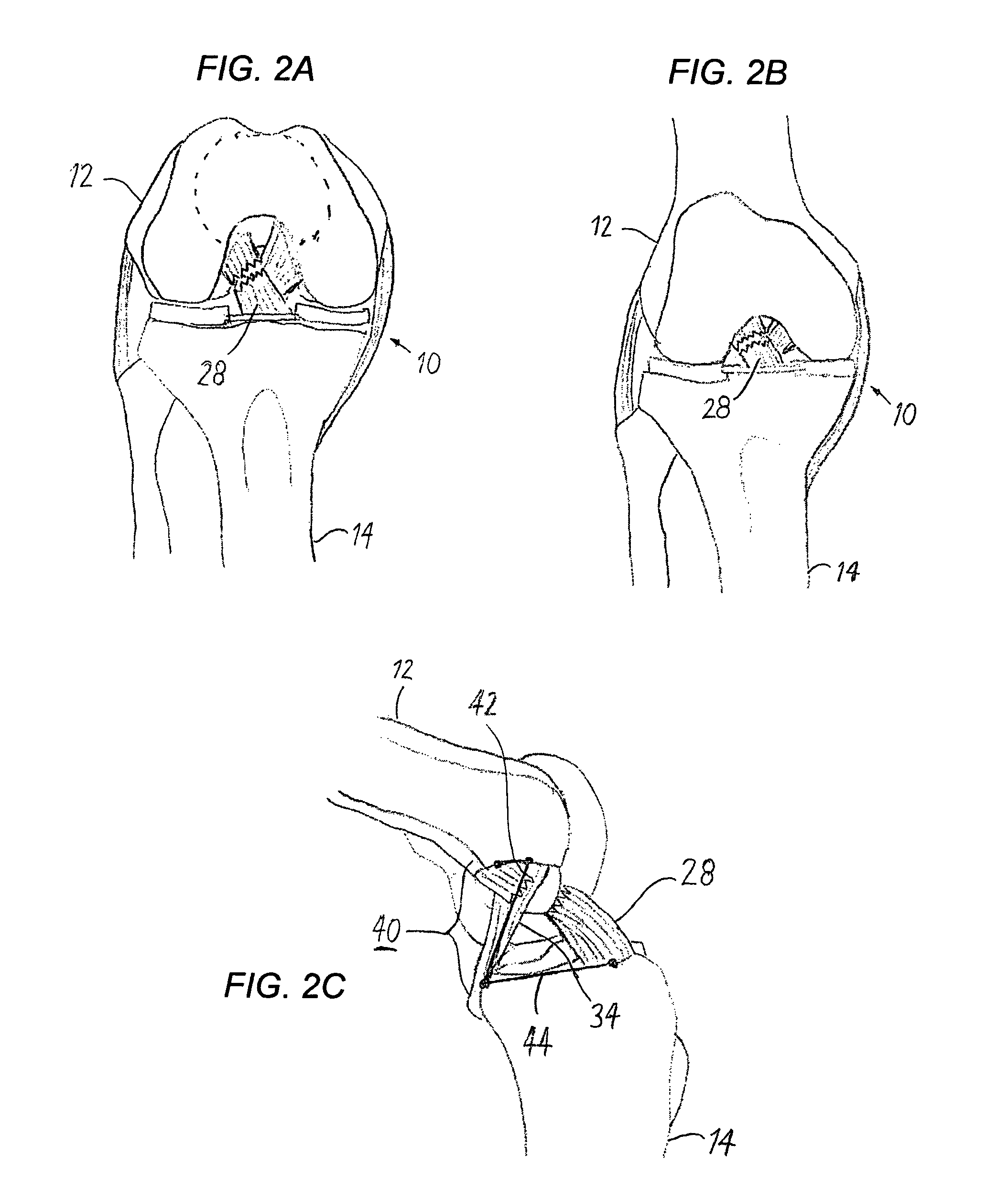 Anterior cruciate ligament tether