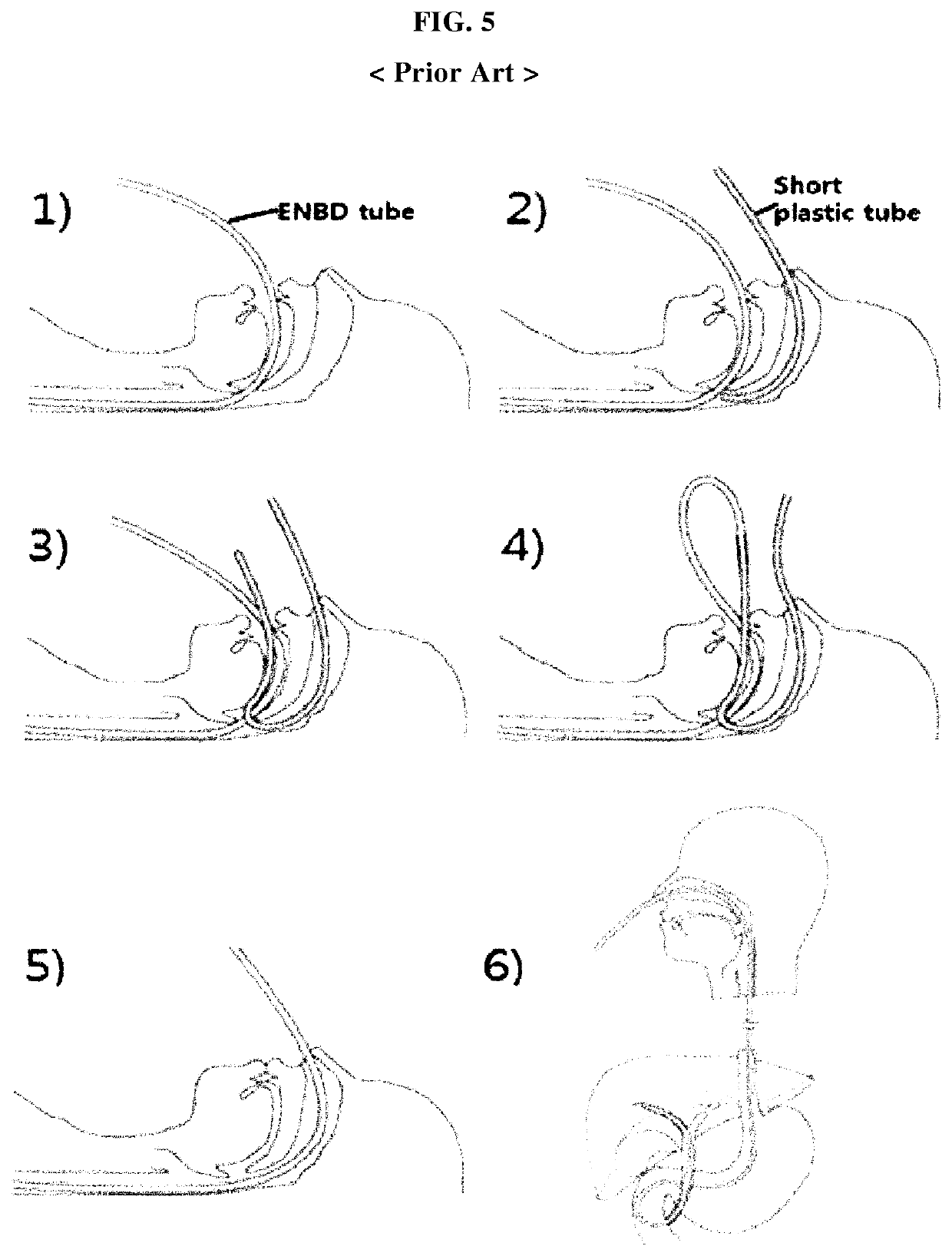 Device for oral-to-nasal repositioning of nasobiliary drainage tube