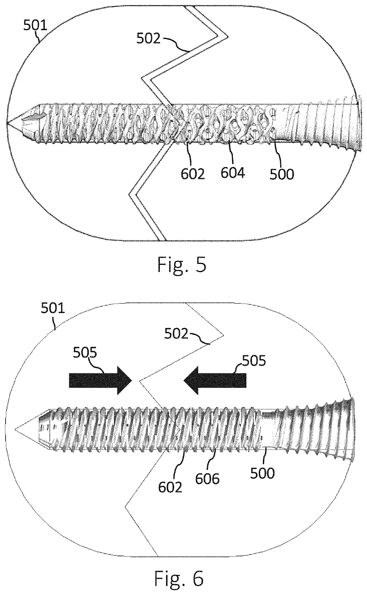 Active compression apparatus, methods of assembly and methods of use