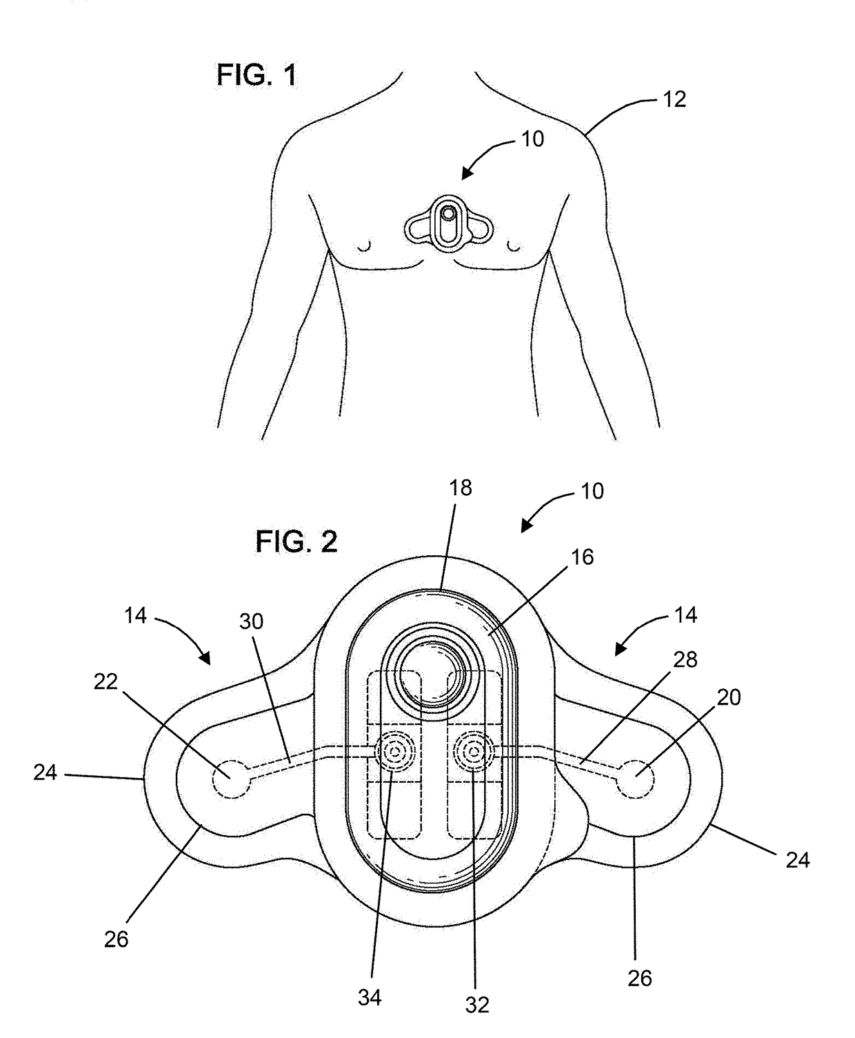 Ambulatory monitor with conductive adhesive and related methods