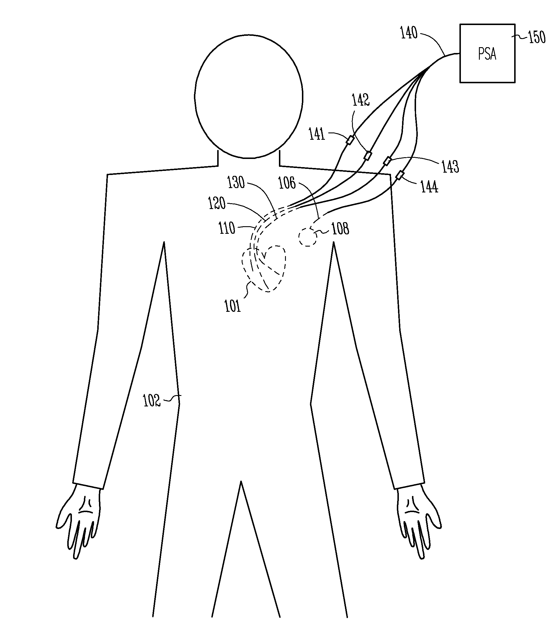 Pacing system analyzer having three sensing and pacing channels