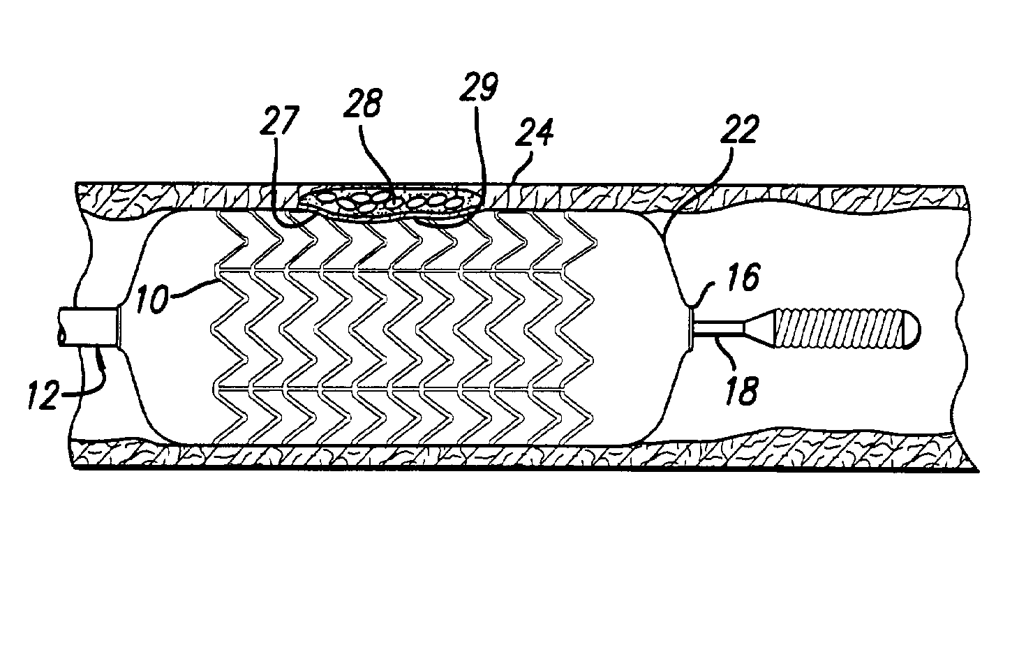 Intravascular stent for treating vulnerable plaque and method of use