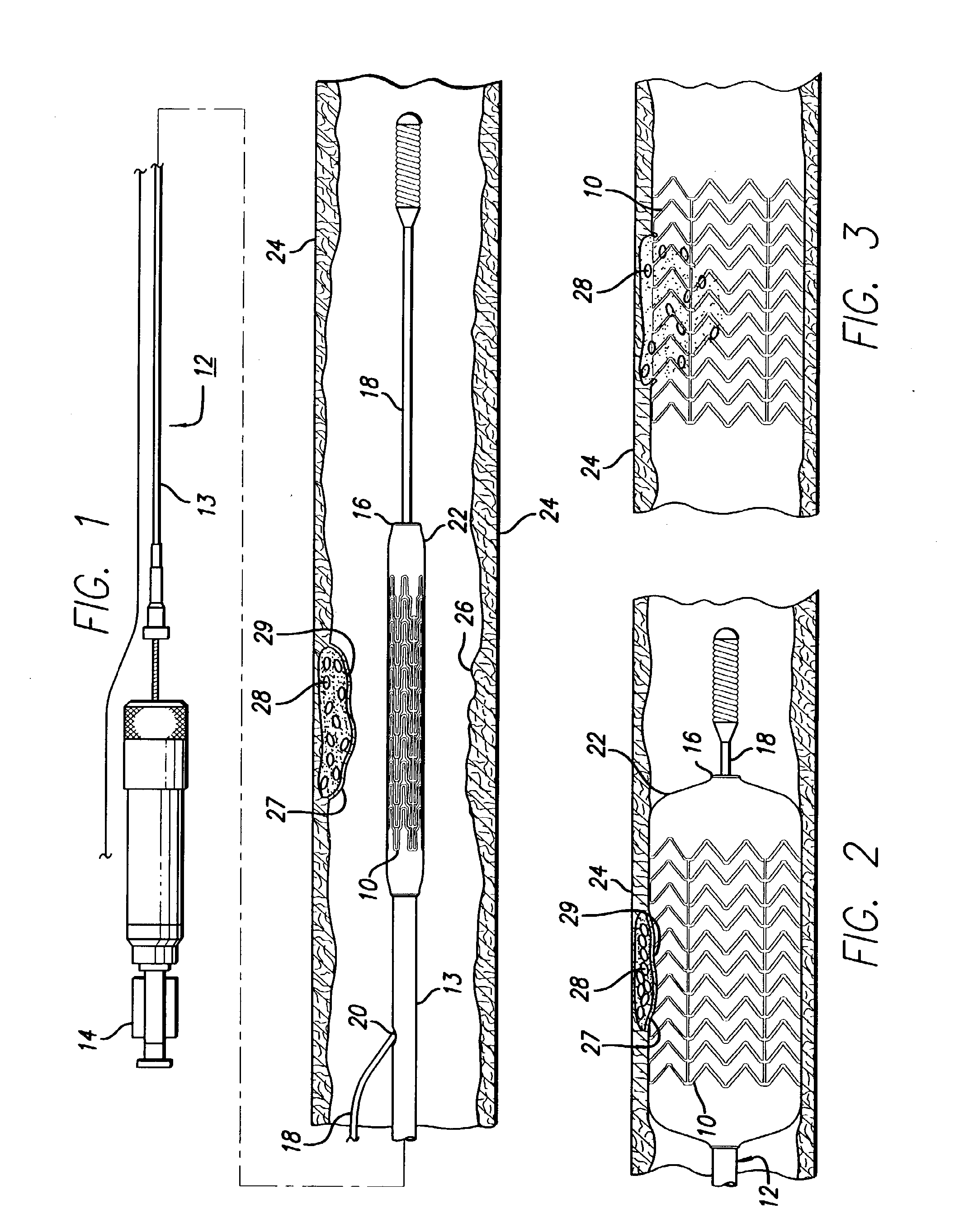 Intravascular stent for treating vulnerable plaque and method of use