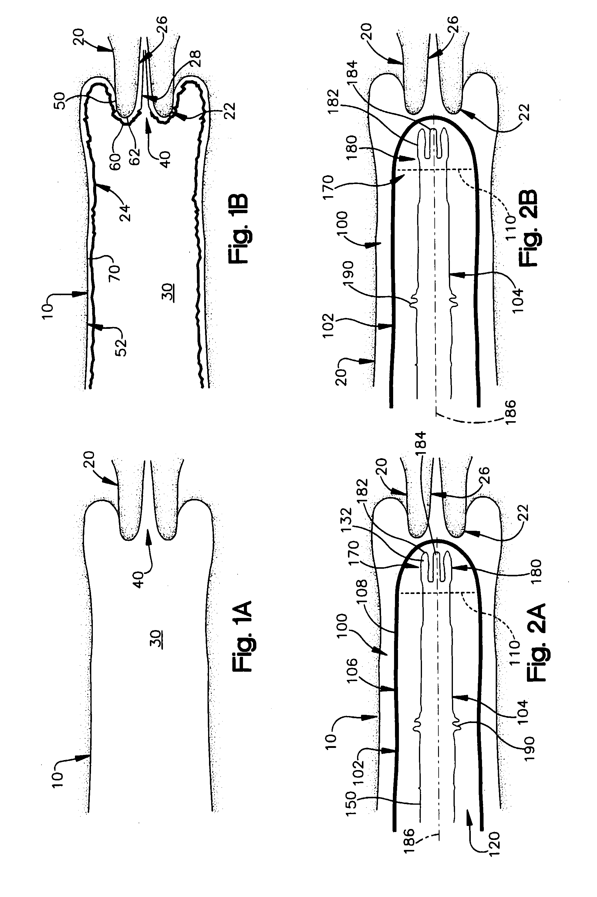 Timing of Ovulation Based on Vaginal Ph