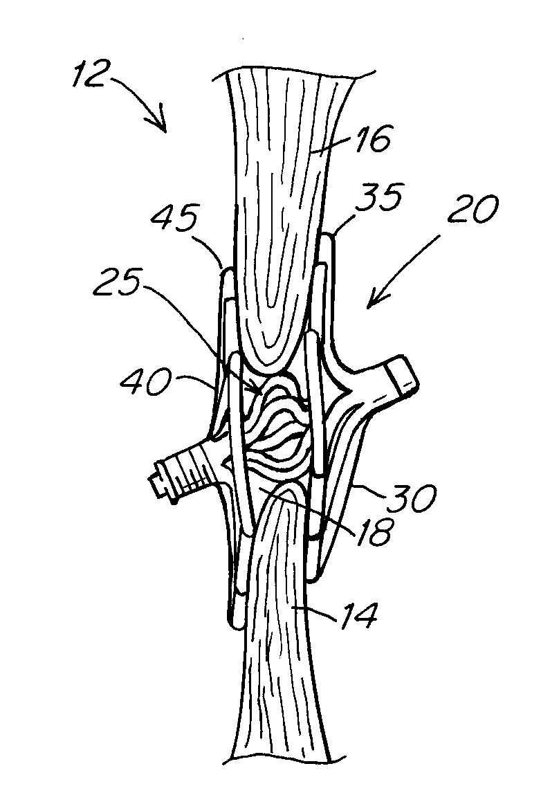 Septal closure device with centering mechanism