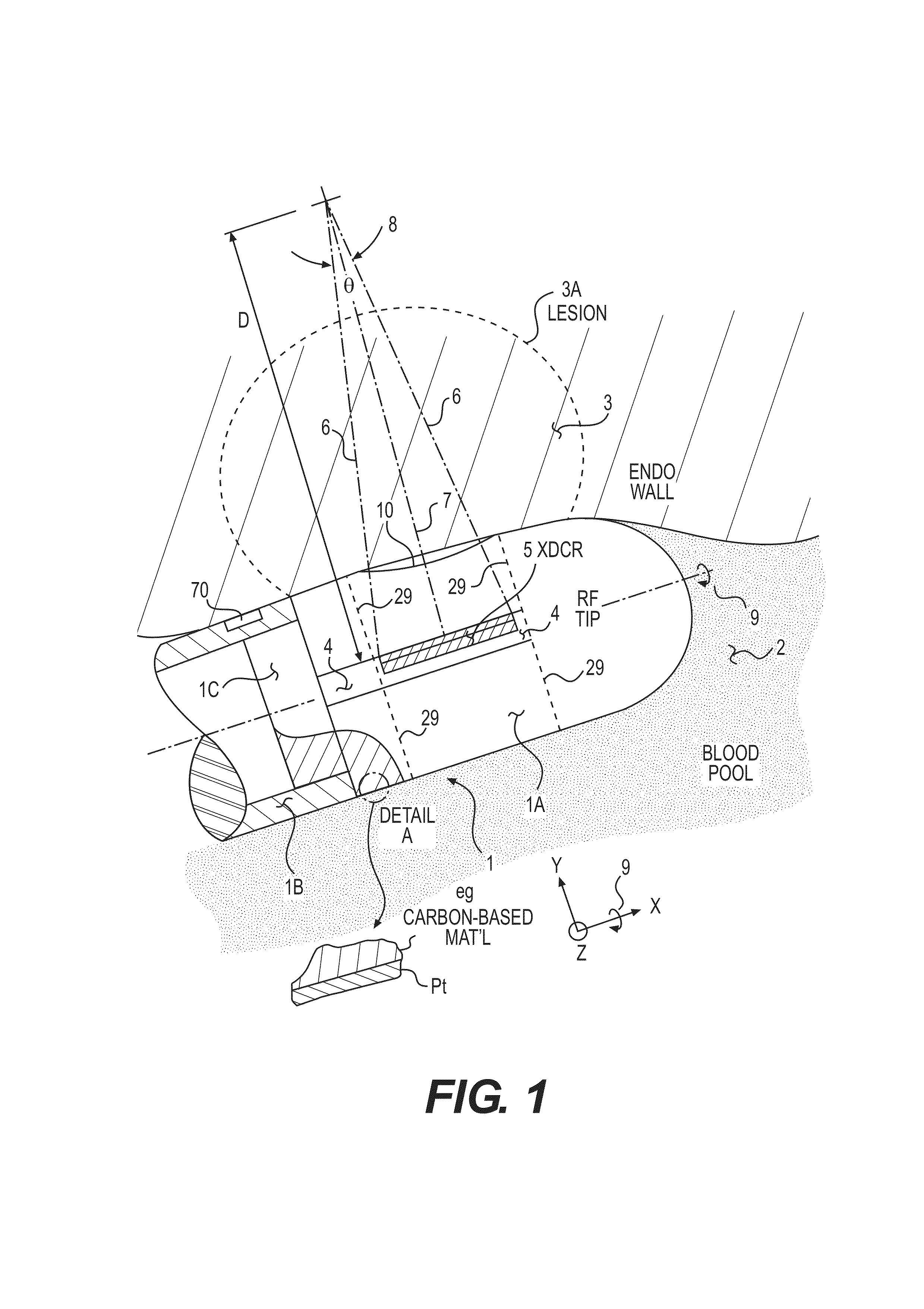 Acoustic transducer for pulse-echo monitoring and control of thermally ablative lesioning in layered and nonlayered tissues, catheter contact monitoring, tissue thickness measurement and pre-pop warning