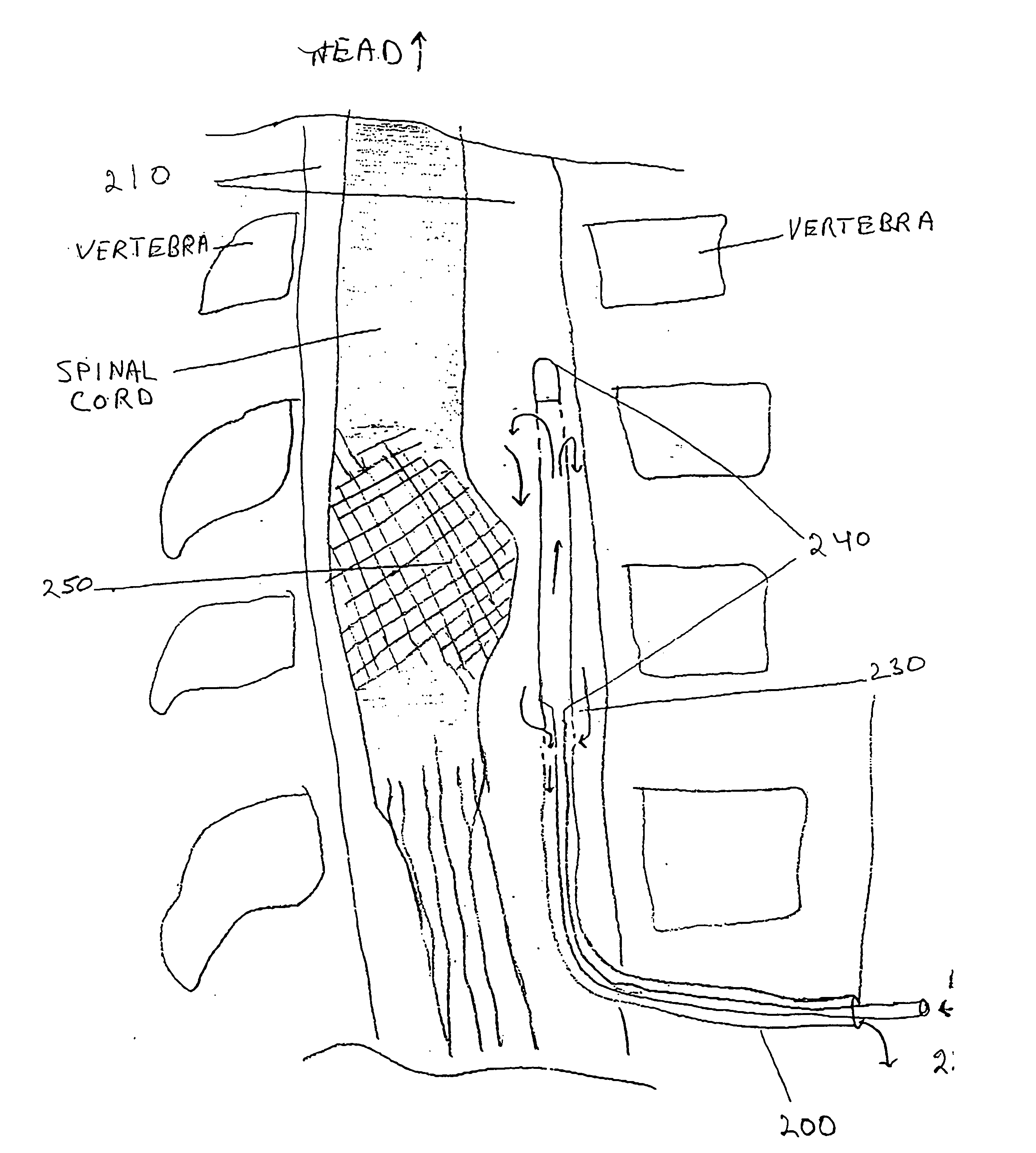 Subarachnoid spinal catheter for transporting cerebrospinal fluid