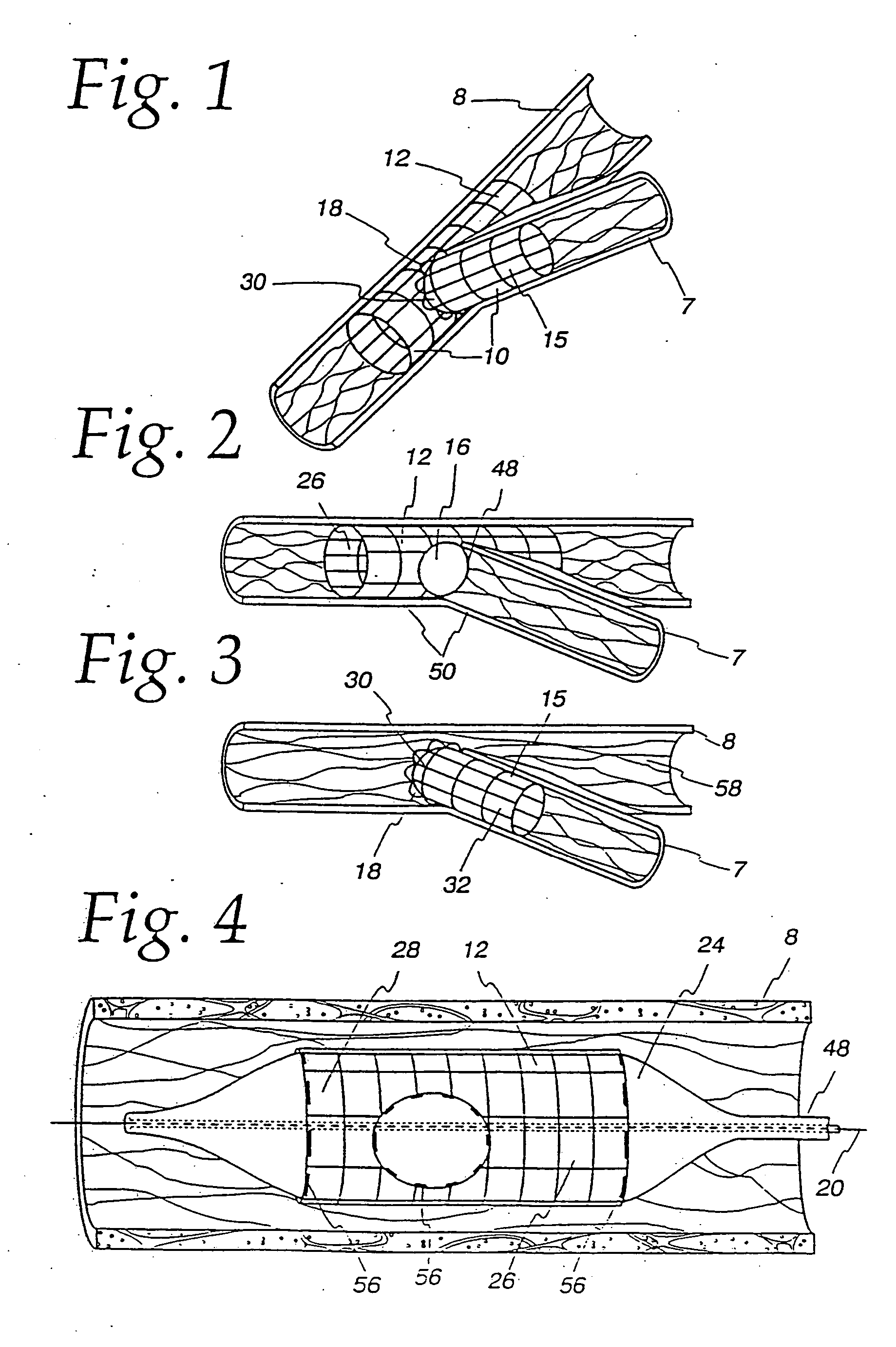 Extendible stent apparatus