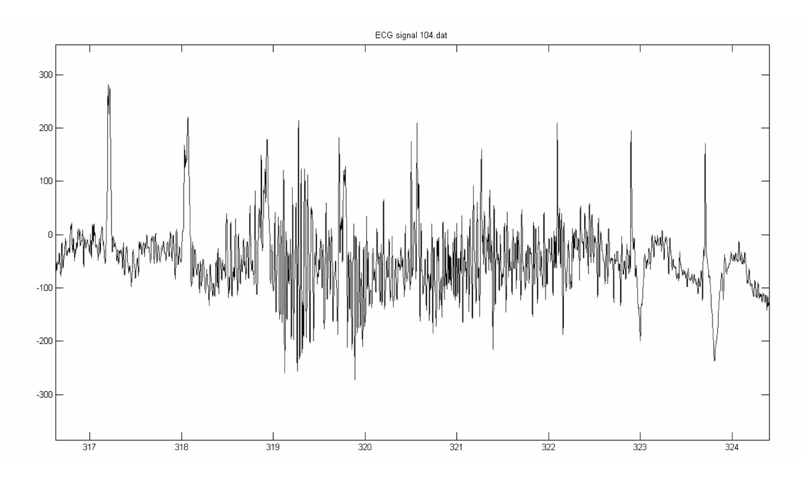 Electrocardiosignal noise analysis method