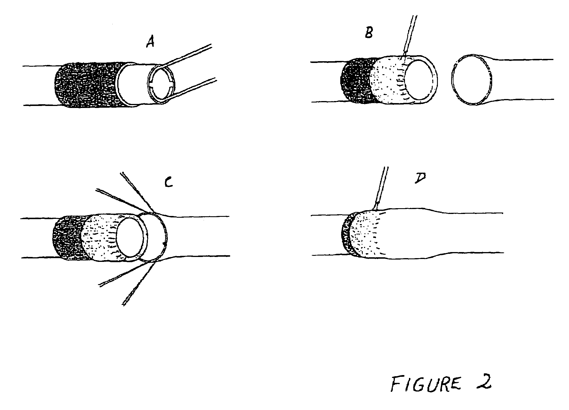 Method of tissue repair II