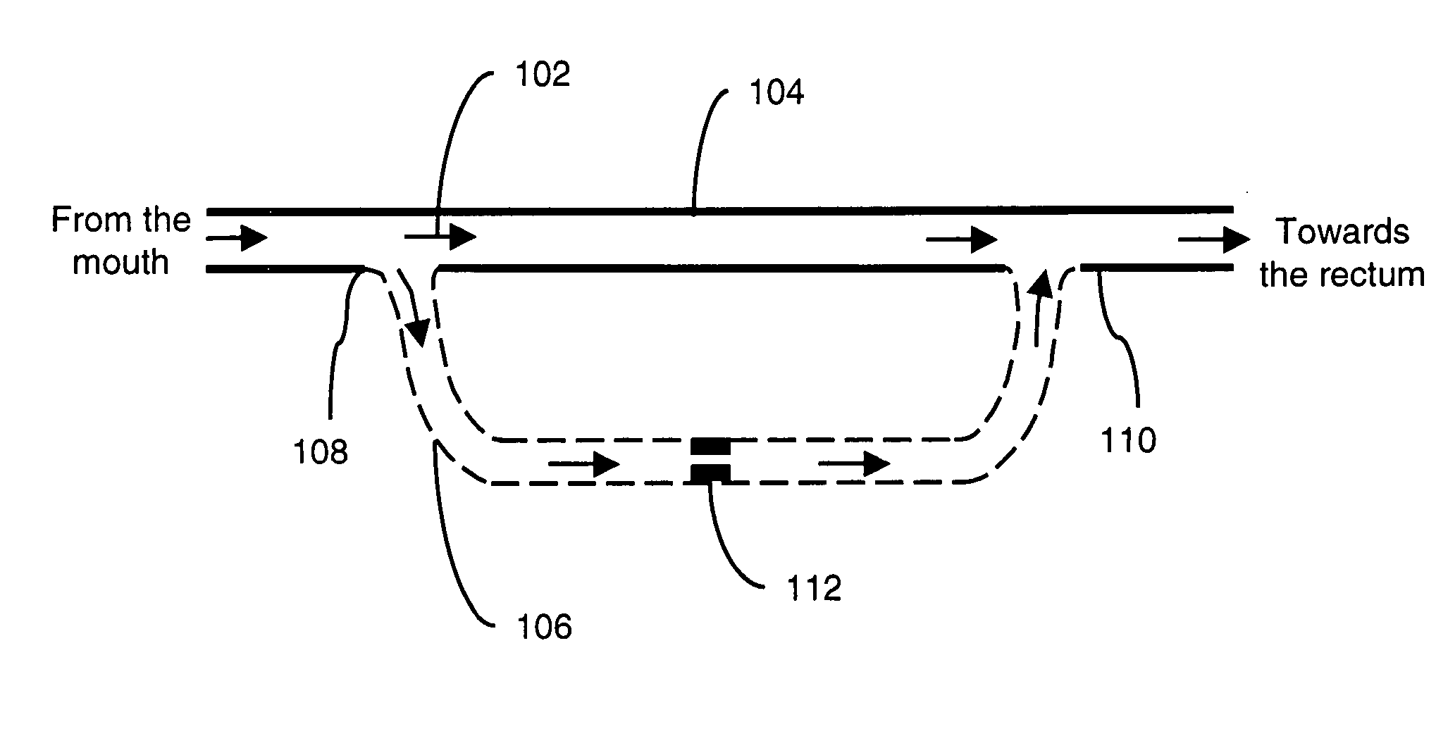 Method and device for gastrointestinal bypass