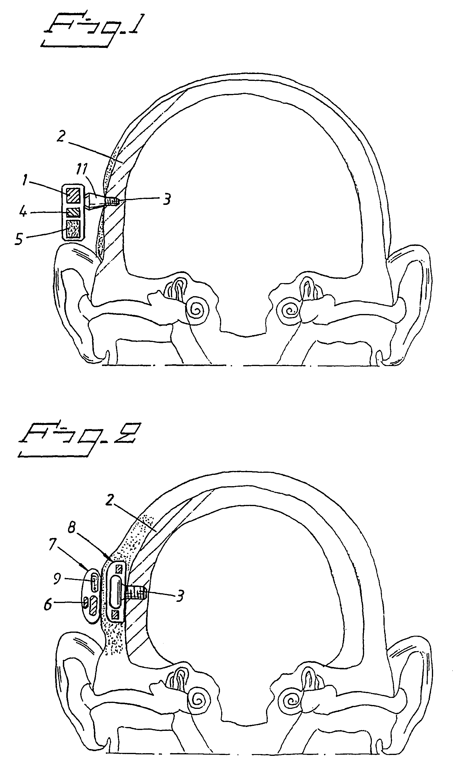 Hearing aid apparatus