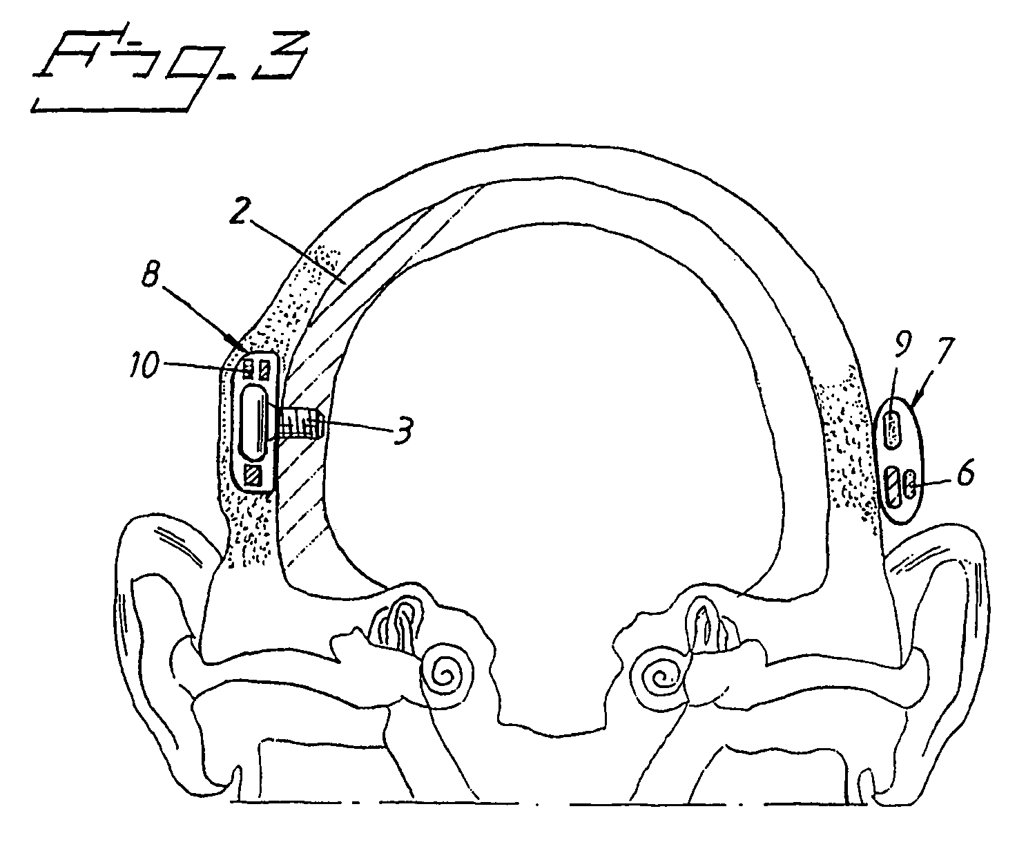 Hearing aid apparatus