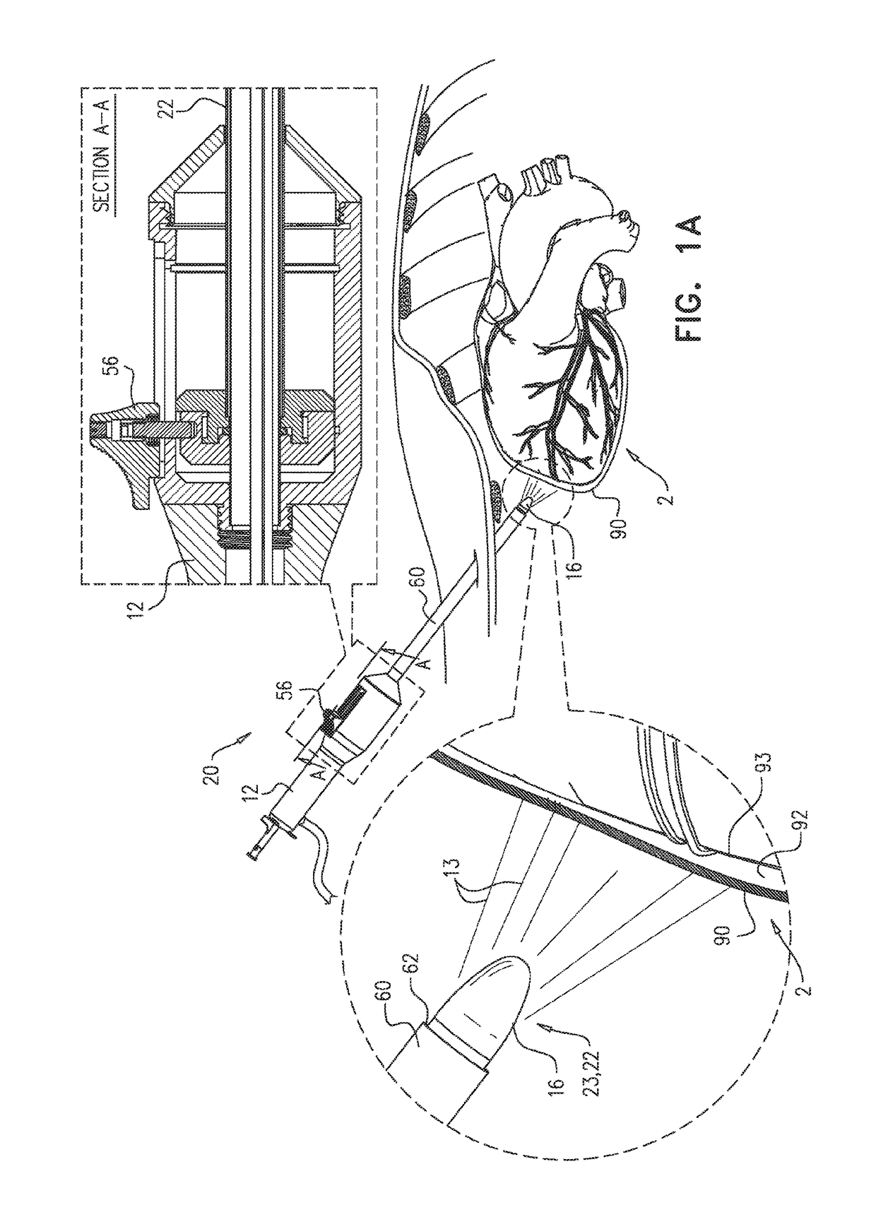 Left atrial appendage closure