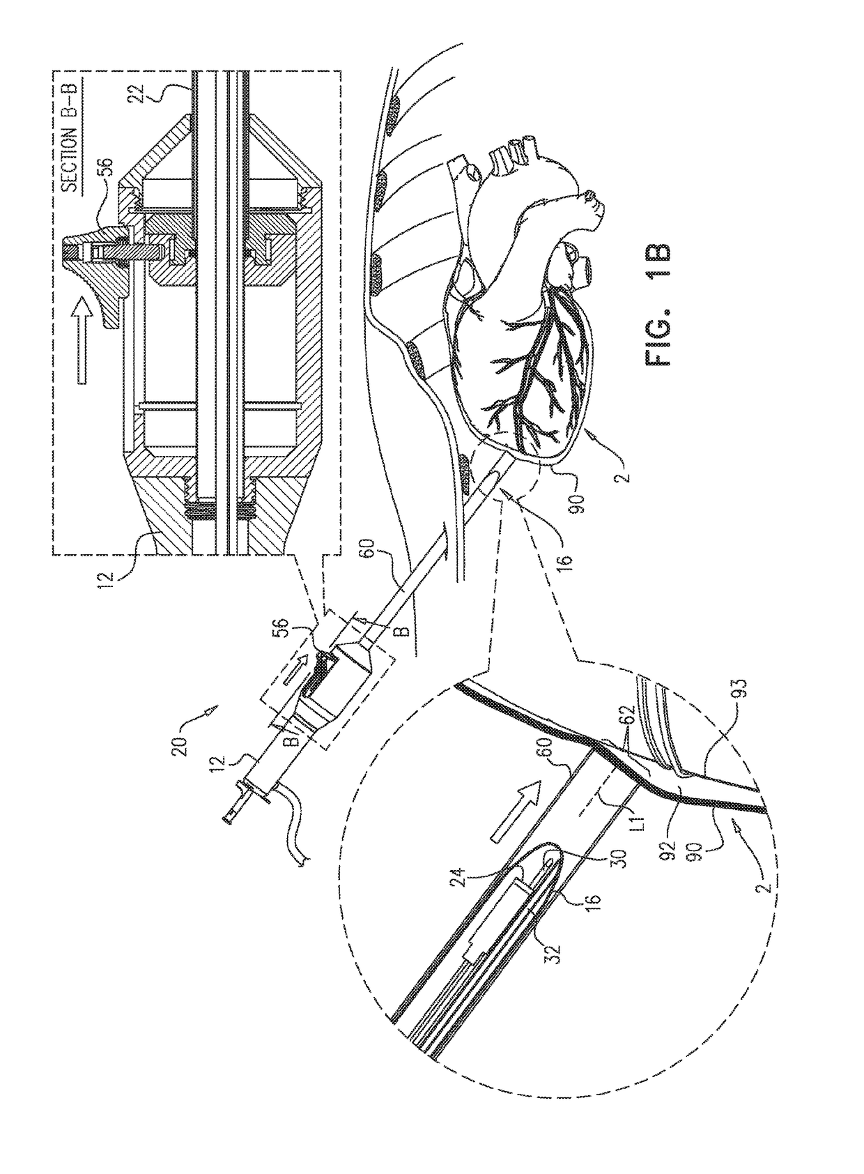 Left atrial appendage closure