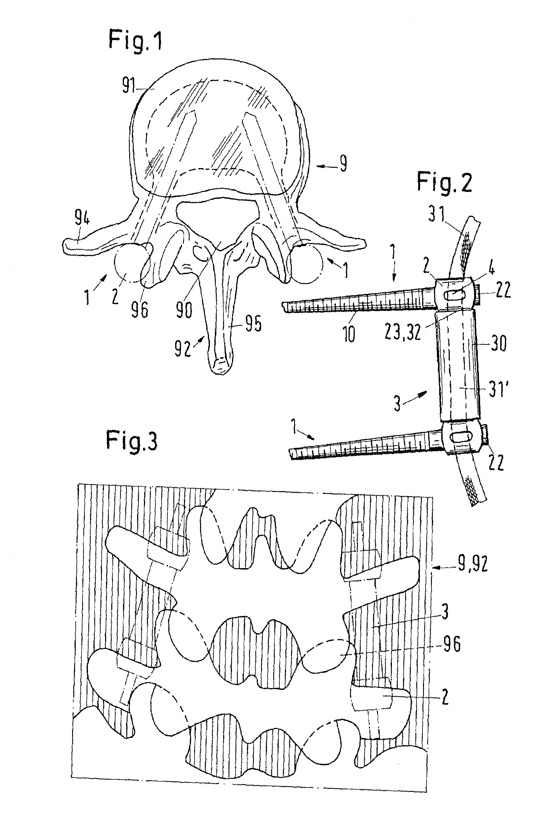 Pedicle screw for intervertebral support elements