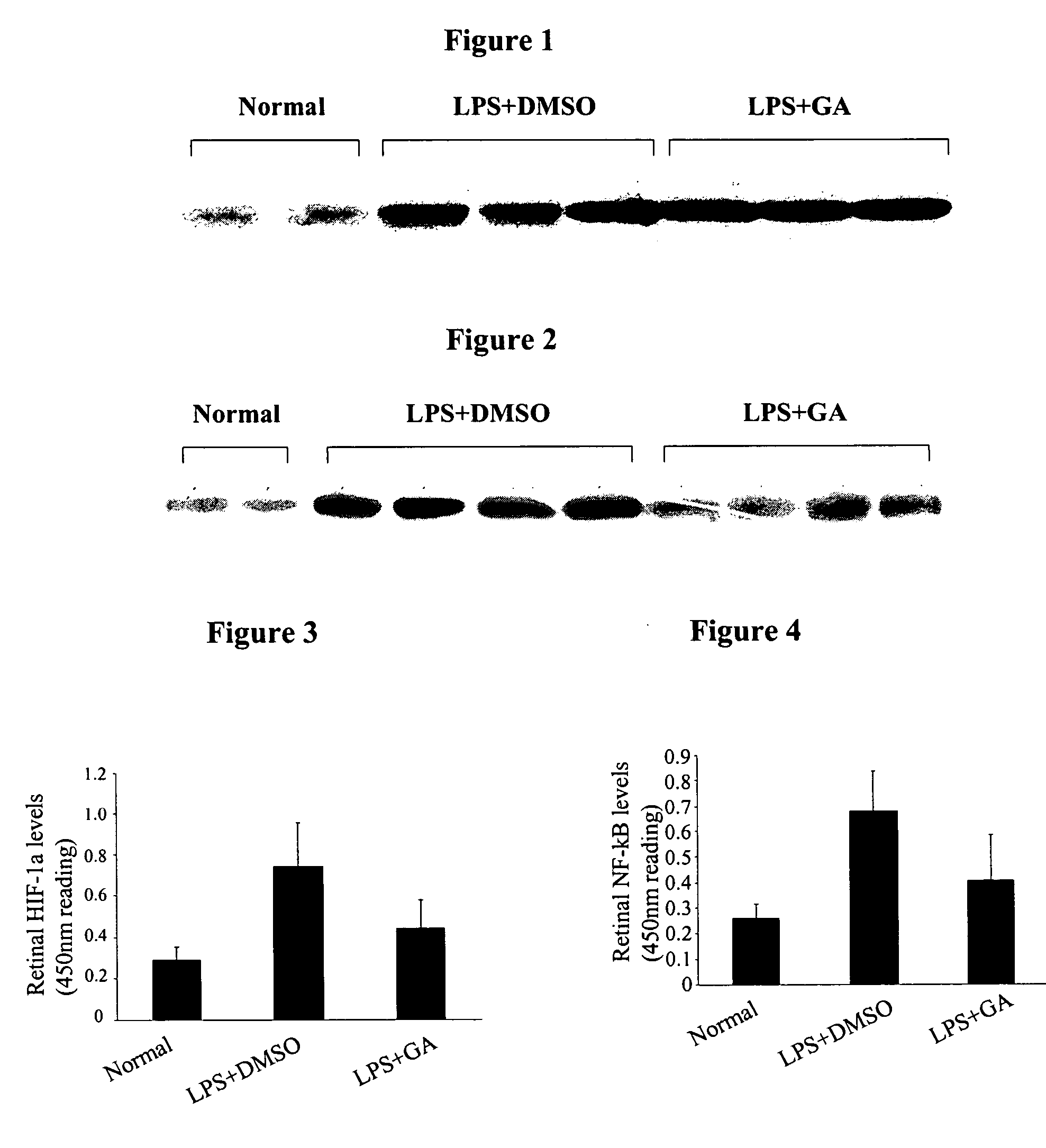 Inflammatory eye disease