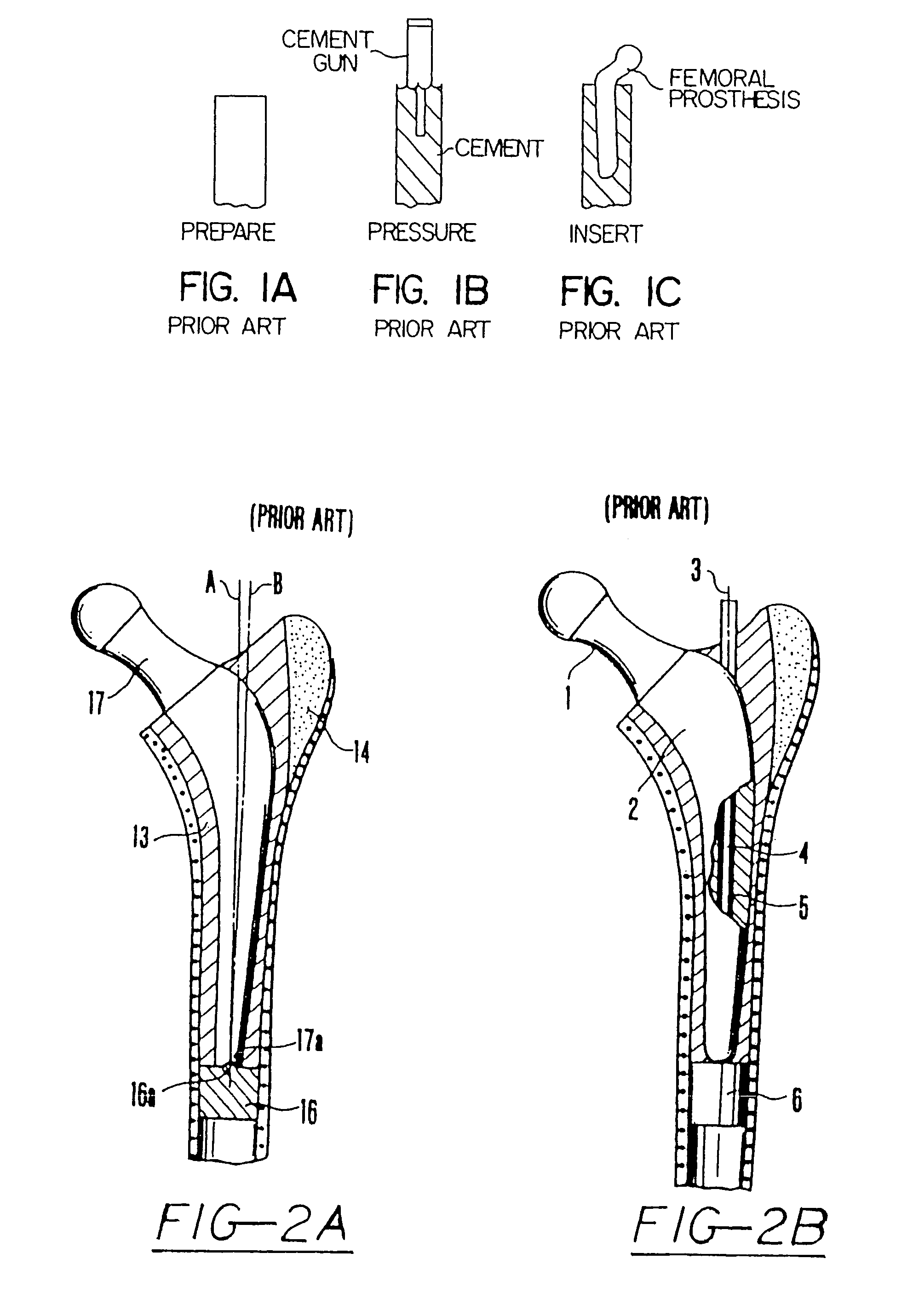 Shoulder prosthesis with anatomic reattachment features