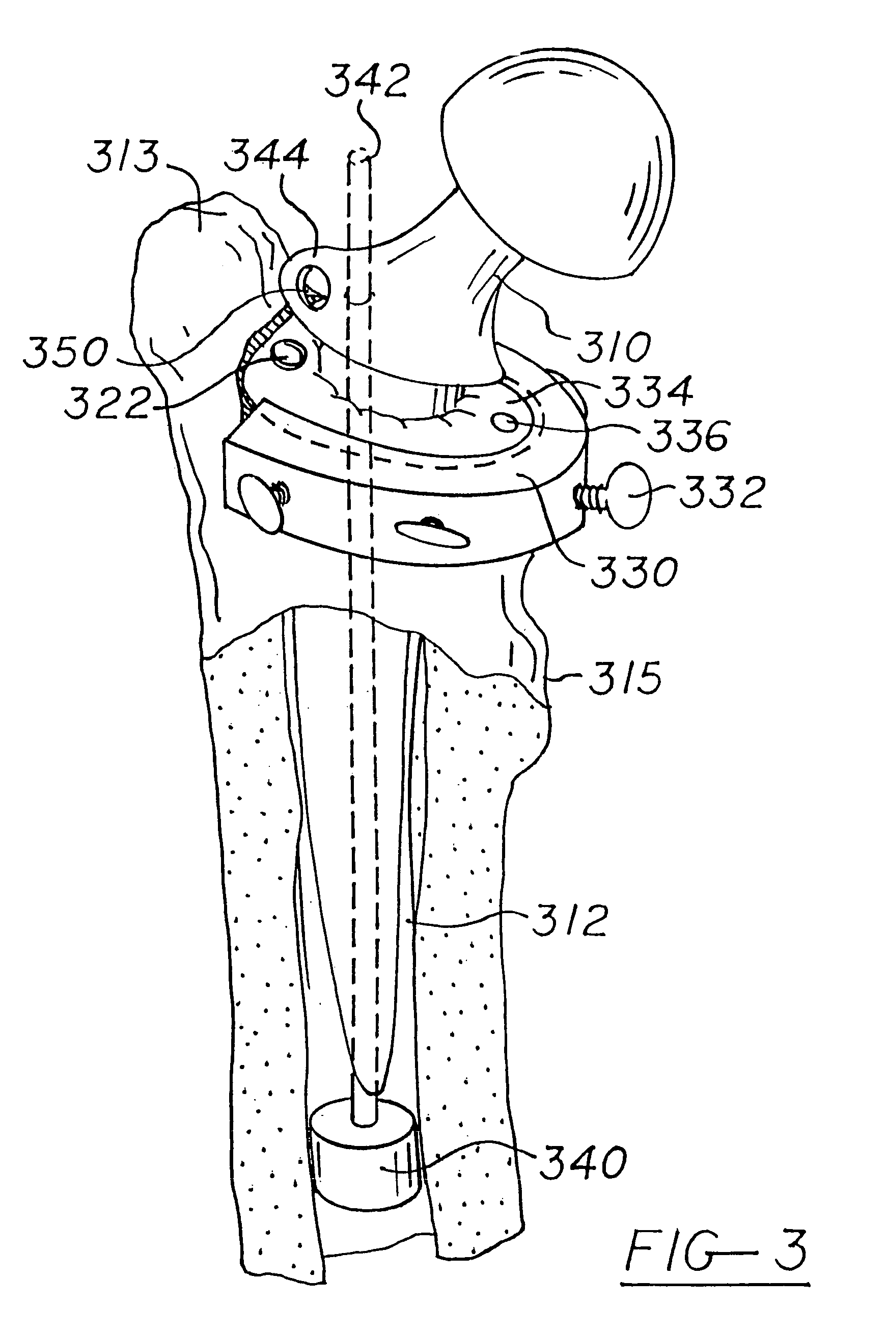 Shoulder prosthesis with anatomic reattachment features