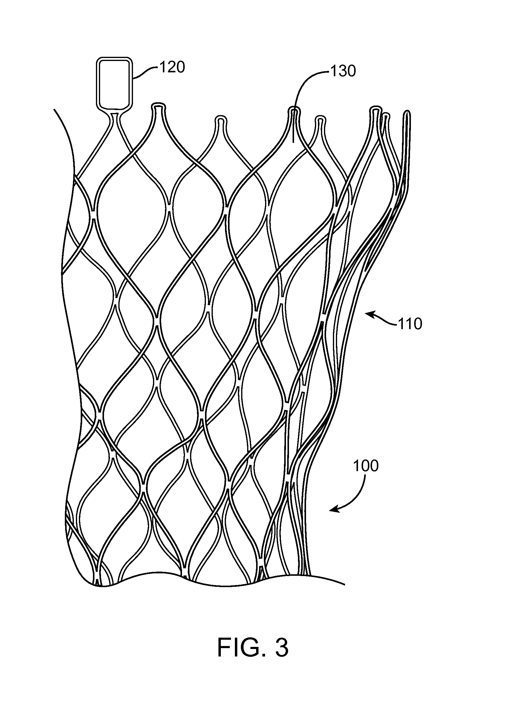 Valve Prosthesis