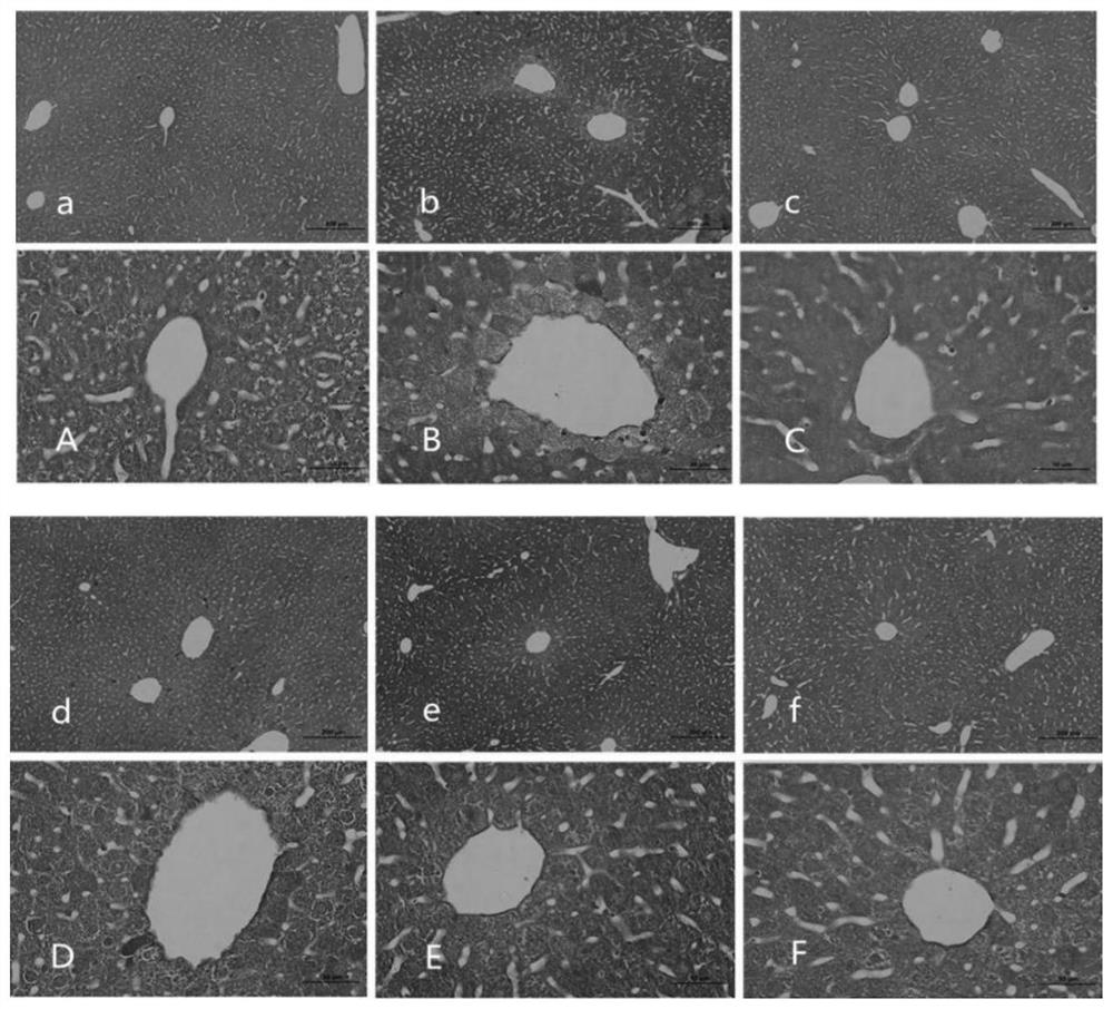 New application of algin in treatment of hepatolenticular degeneration