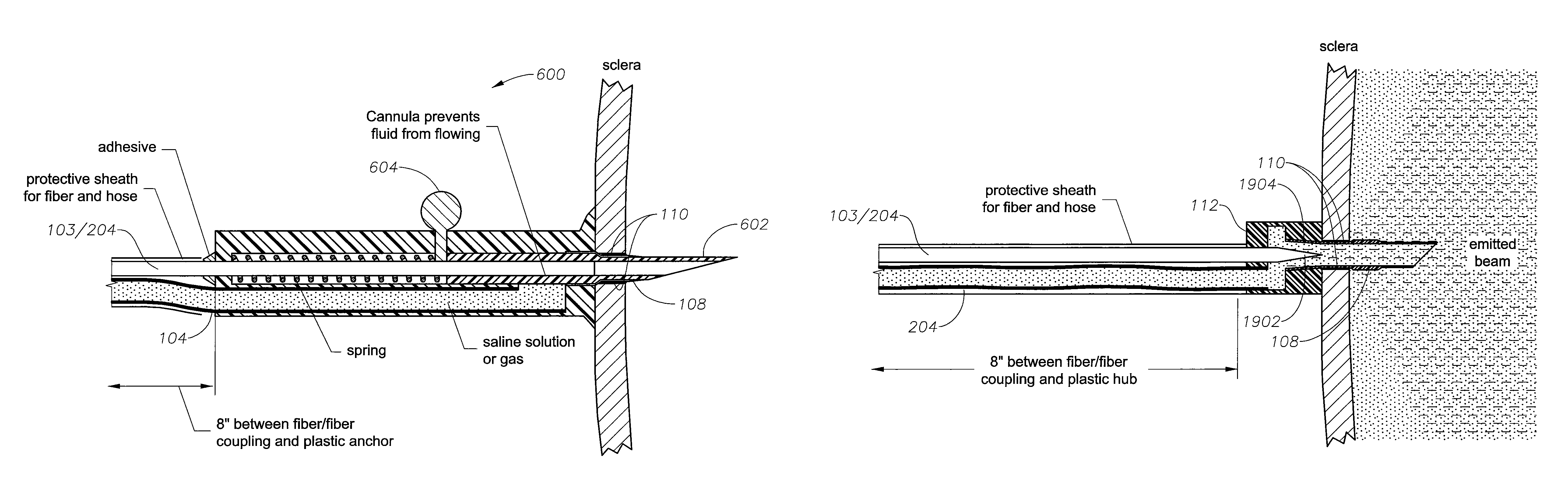 Illuminated infusion cannula