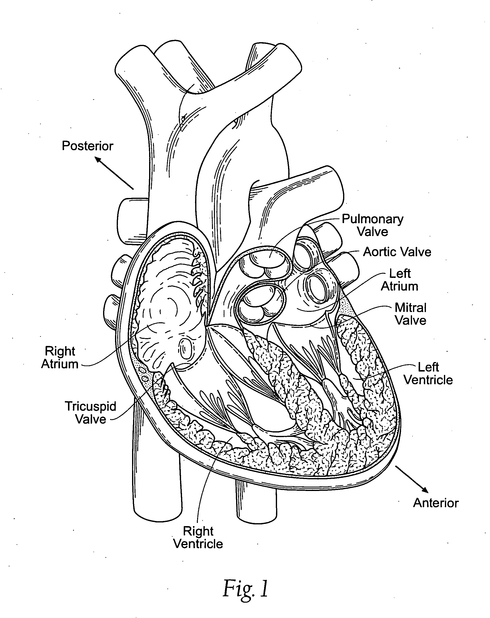 Devices, systems, and methods for reshaping a heart valve annulus