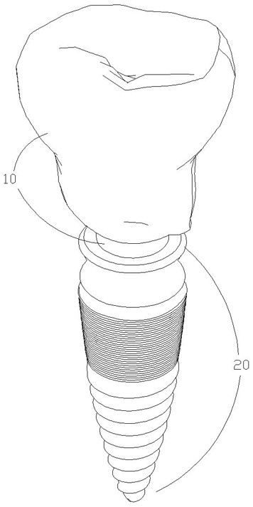 Implant tooth