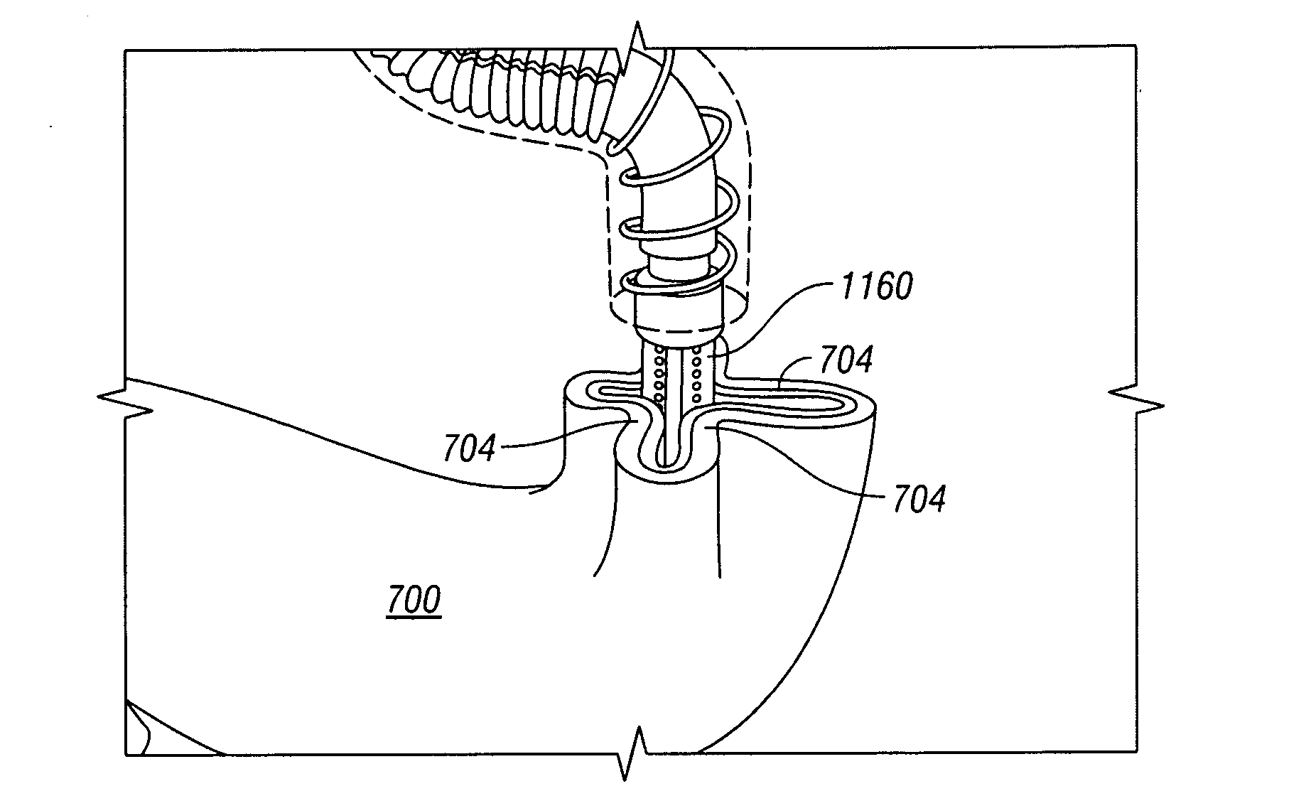 Apparatus and method for gastric reduction