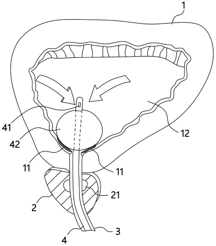 Urethral stent tube used after hypospadias repair